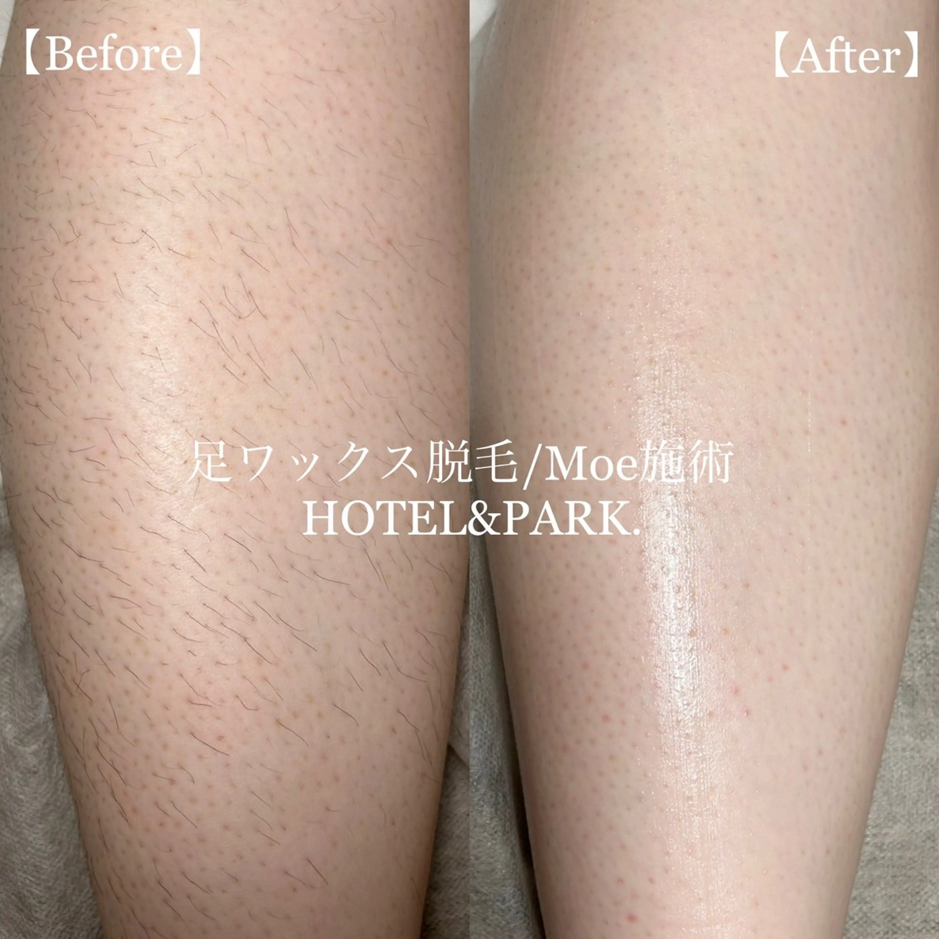 脱毛 HOTEL&PARK .Moeワックス脱毛のエステ・リラクイメージ