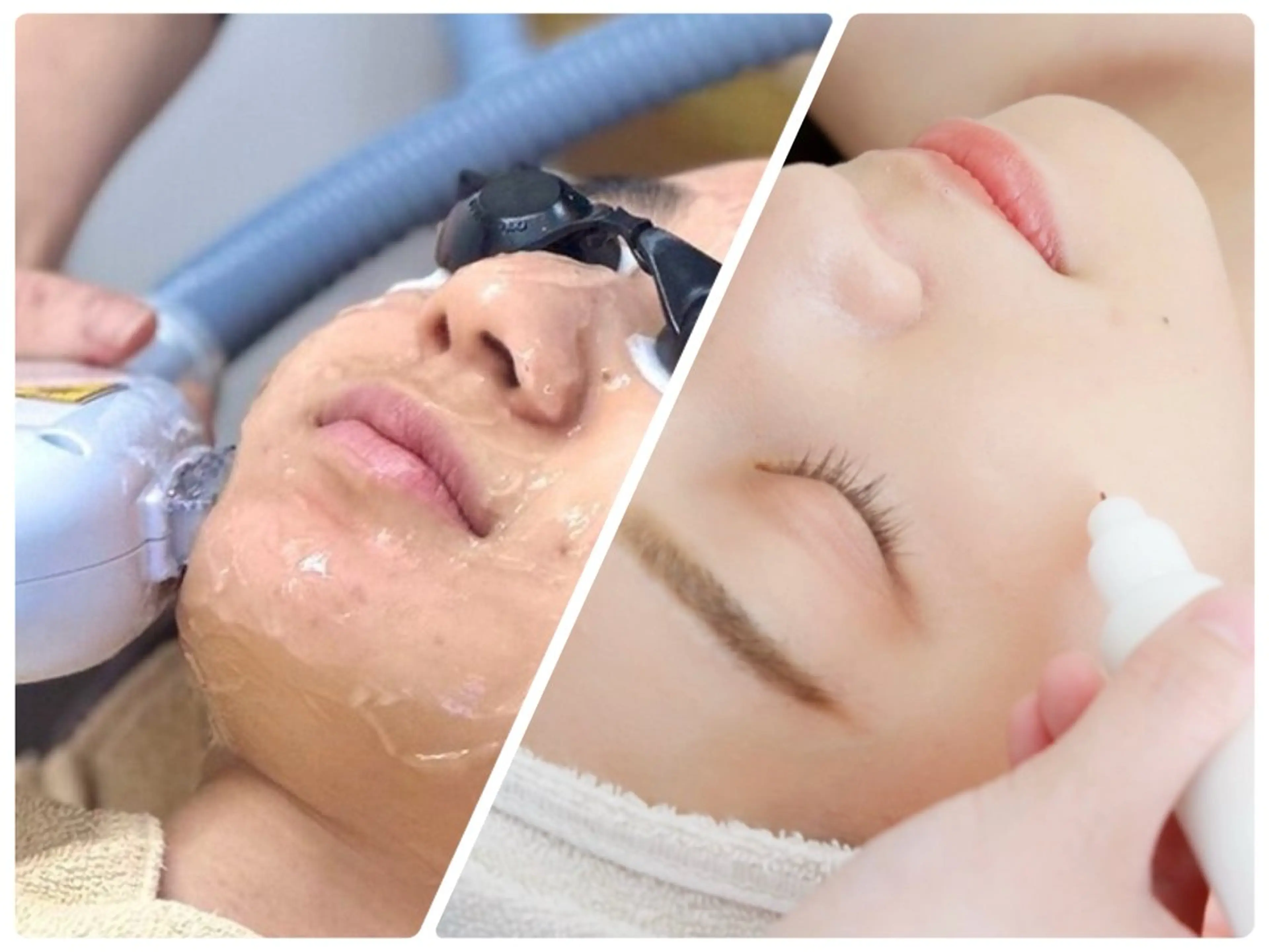 【低周波シミケア20分+光フェイシャル】シミ/毛穴/ニキビ/くすみ/シワ/たるみ/リフトアップ/ターンオーバーの写真