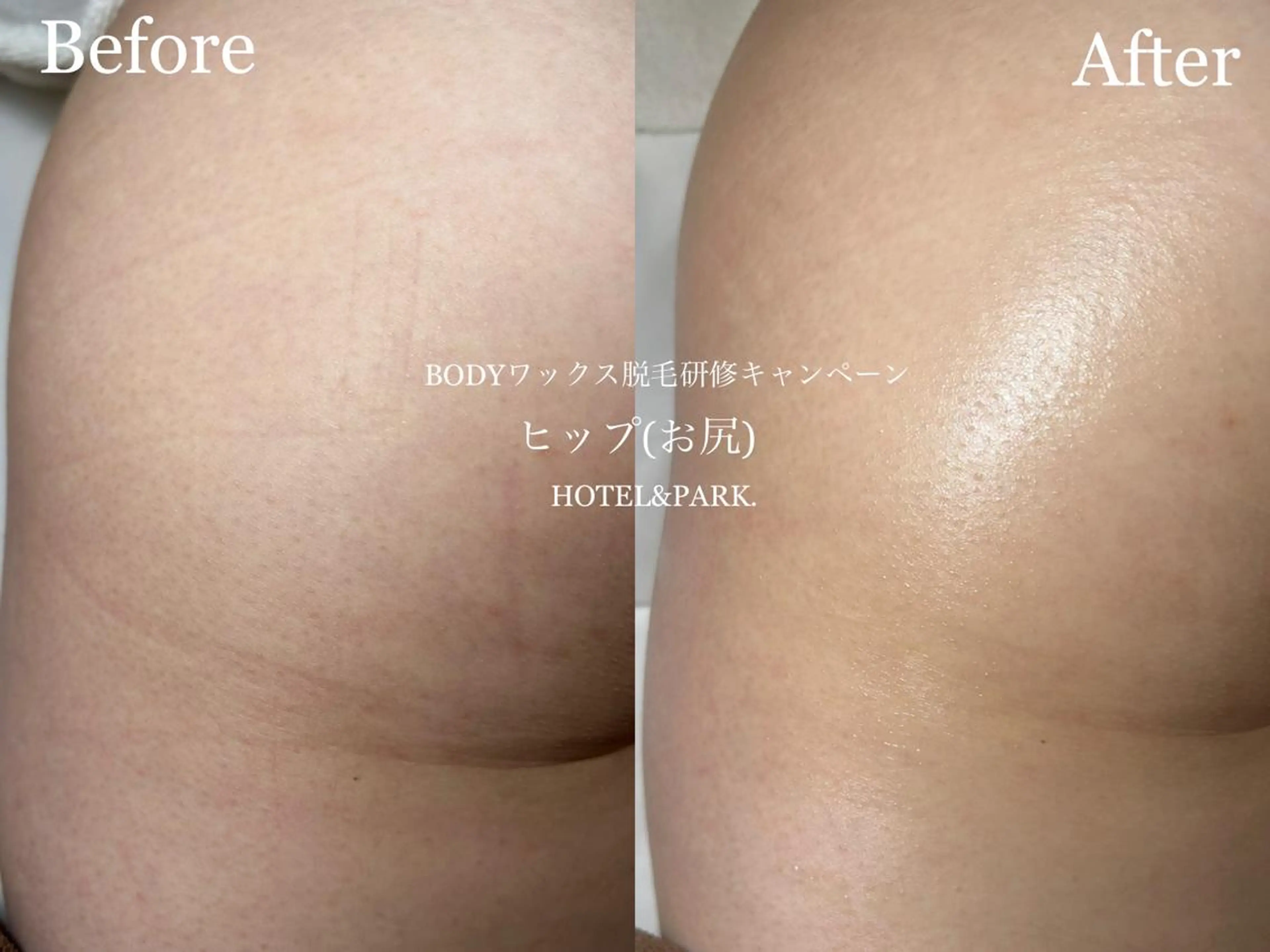 HOTEL&PARK . ワックス脱毛のエステ・リラクイメージ