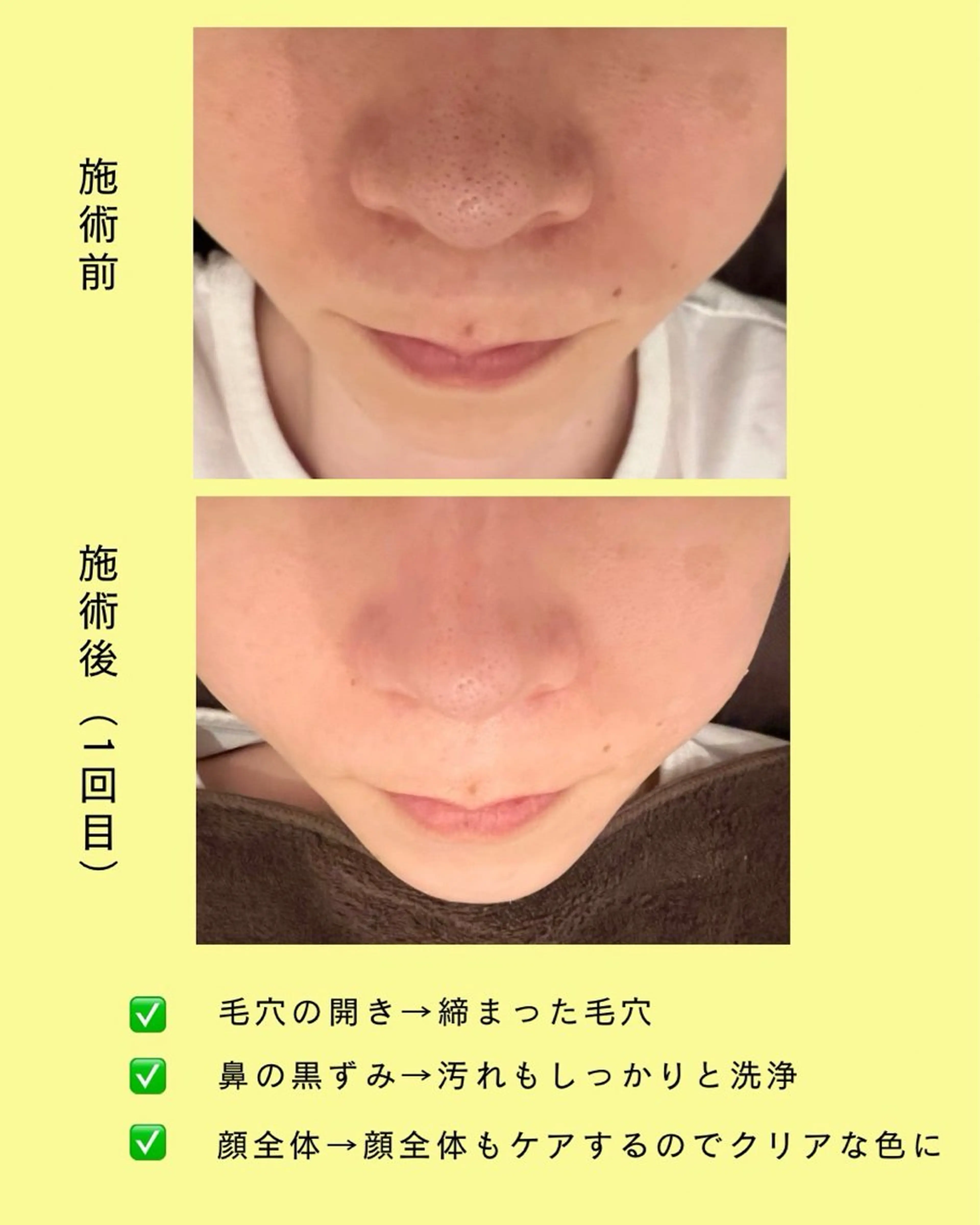 【毛穴・肌荒れ集中⚡️】水素水ハイドロフェイシャル&デコルテケア(ヒアリング込み)の写真