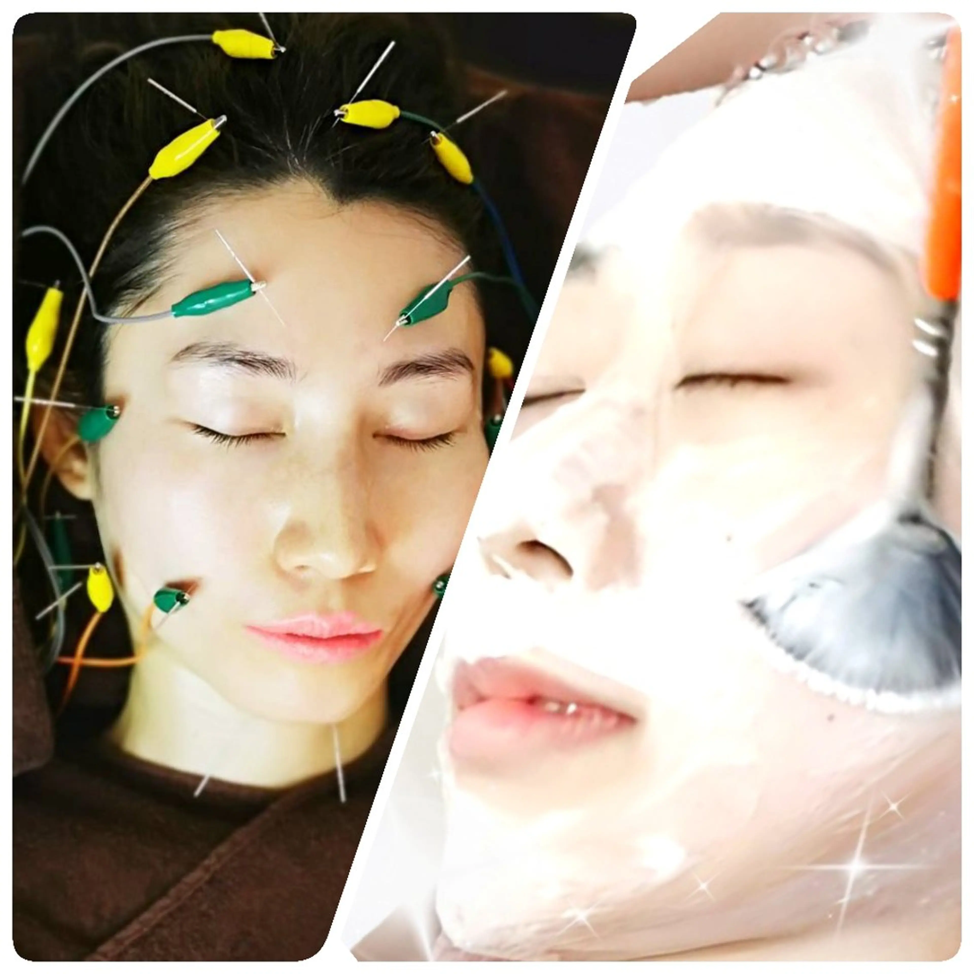 【小顔・透明感・ツヤ肌】ララピール🍊+美容鍼🪡【ニューハーフ鍼灸師の最強肌管理】の写真