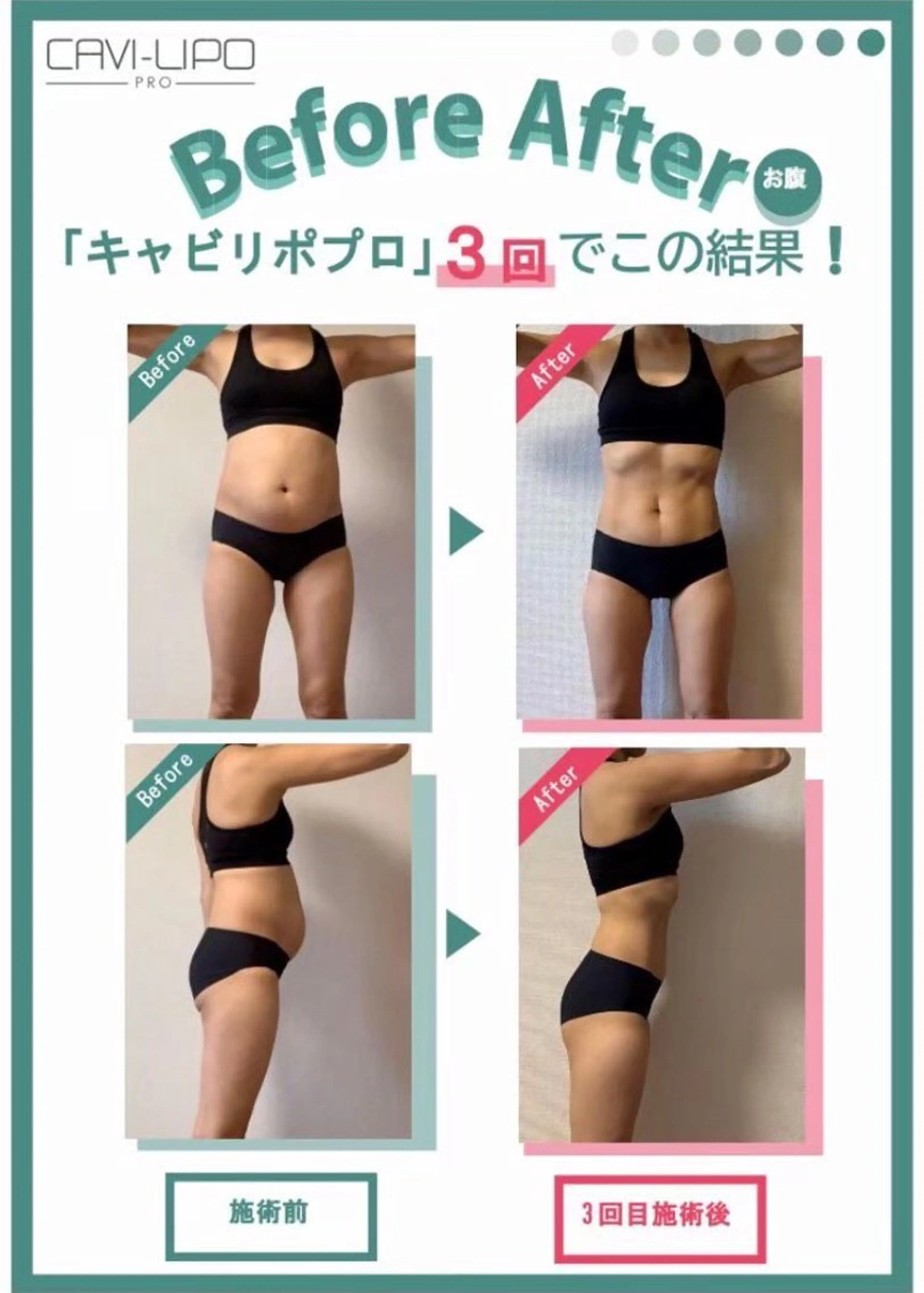 全身大幅サイズダウン【全身スリム】(キャビテーション/ラジオ波/吸引/EMS) 結果重視🔥短期で理想の身体への写真