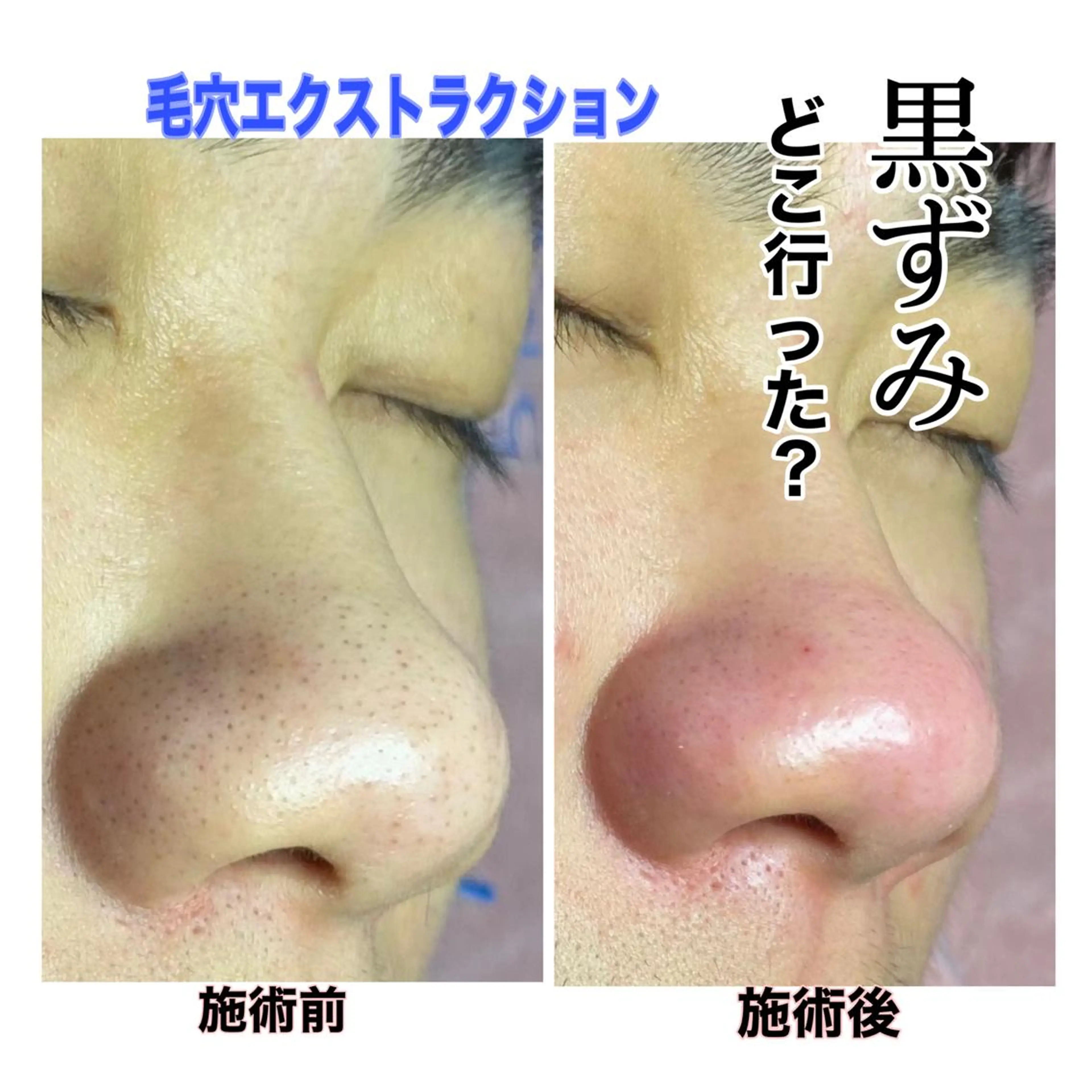 【Pore Skin】【毛穴Skin】  60分!!の写真