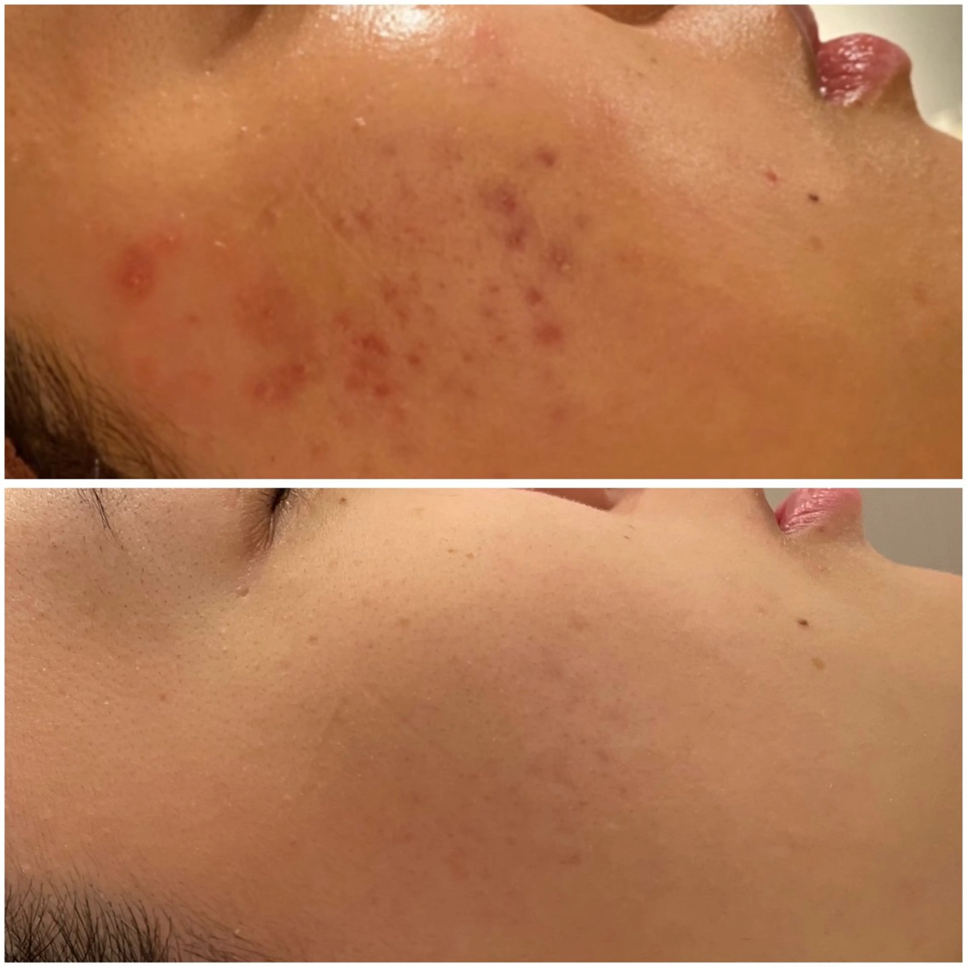 エステ リラク ニキビ特化型エステ 🍓最短で肌質改善のその他イメージ