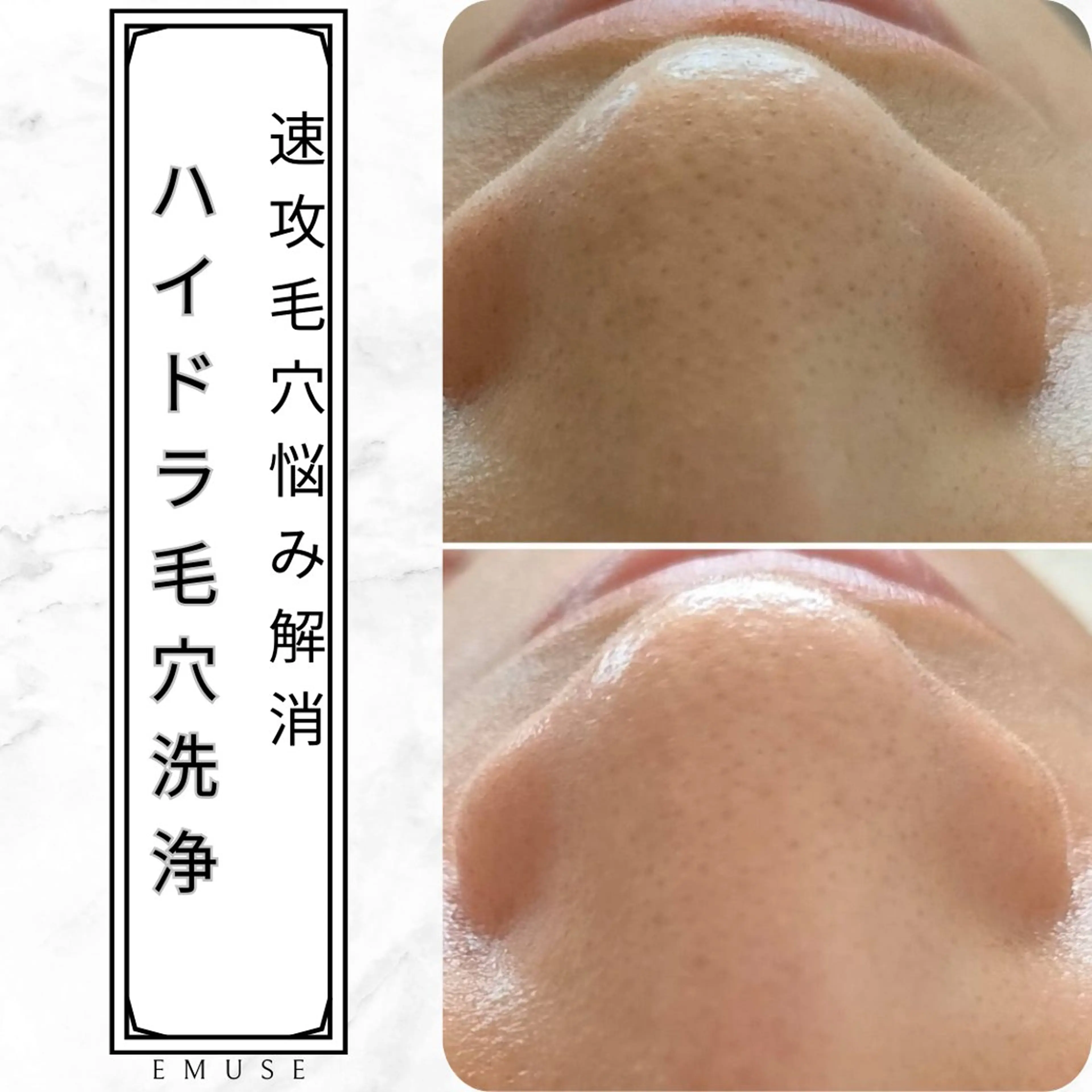 毛穴の黒ずみざらつき撃退！ハイドラ毛穴洗浄の写真