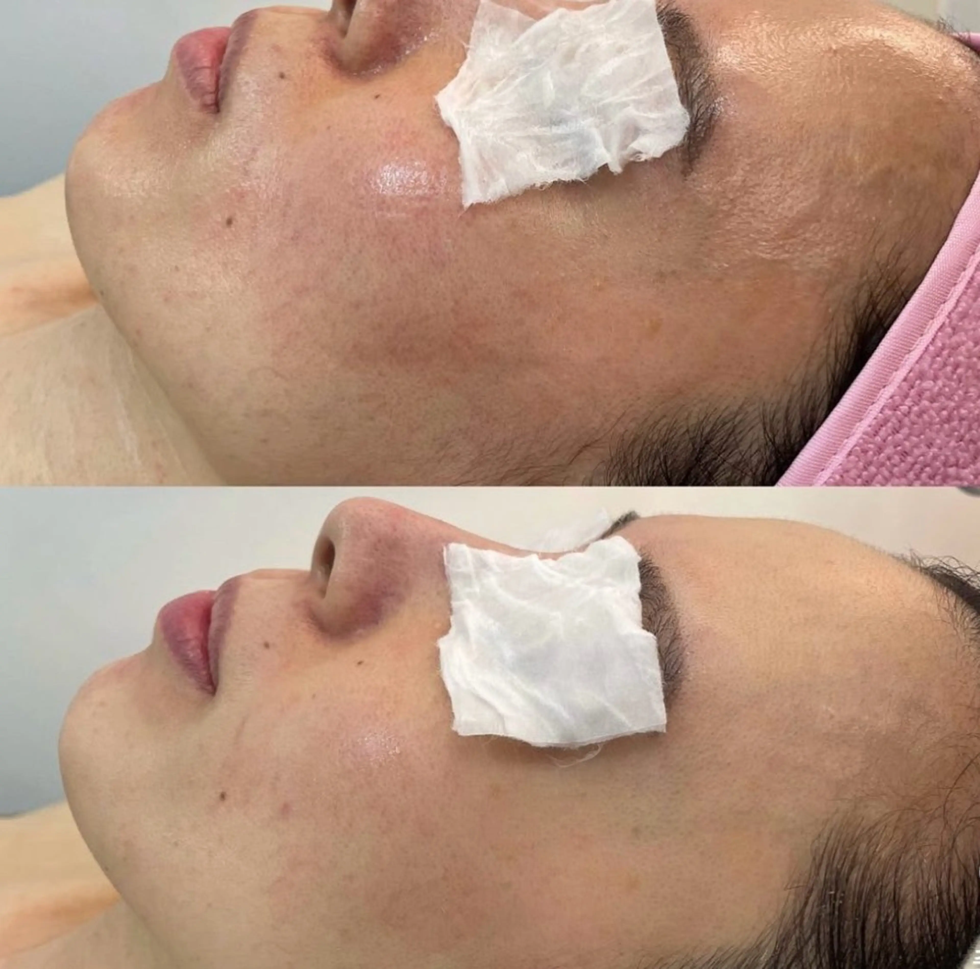 🌿トゲなしオーガニックハーブピーリング敏感肌もOK｜剥けない・痛くない・当日メイク可✨の写真