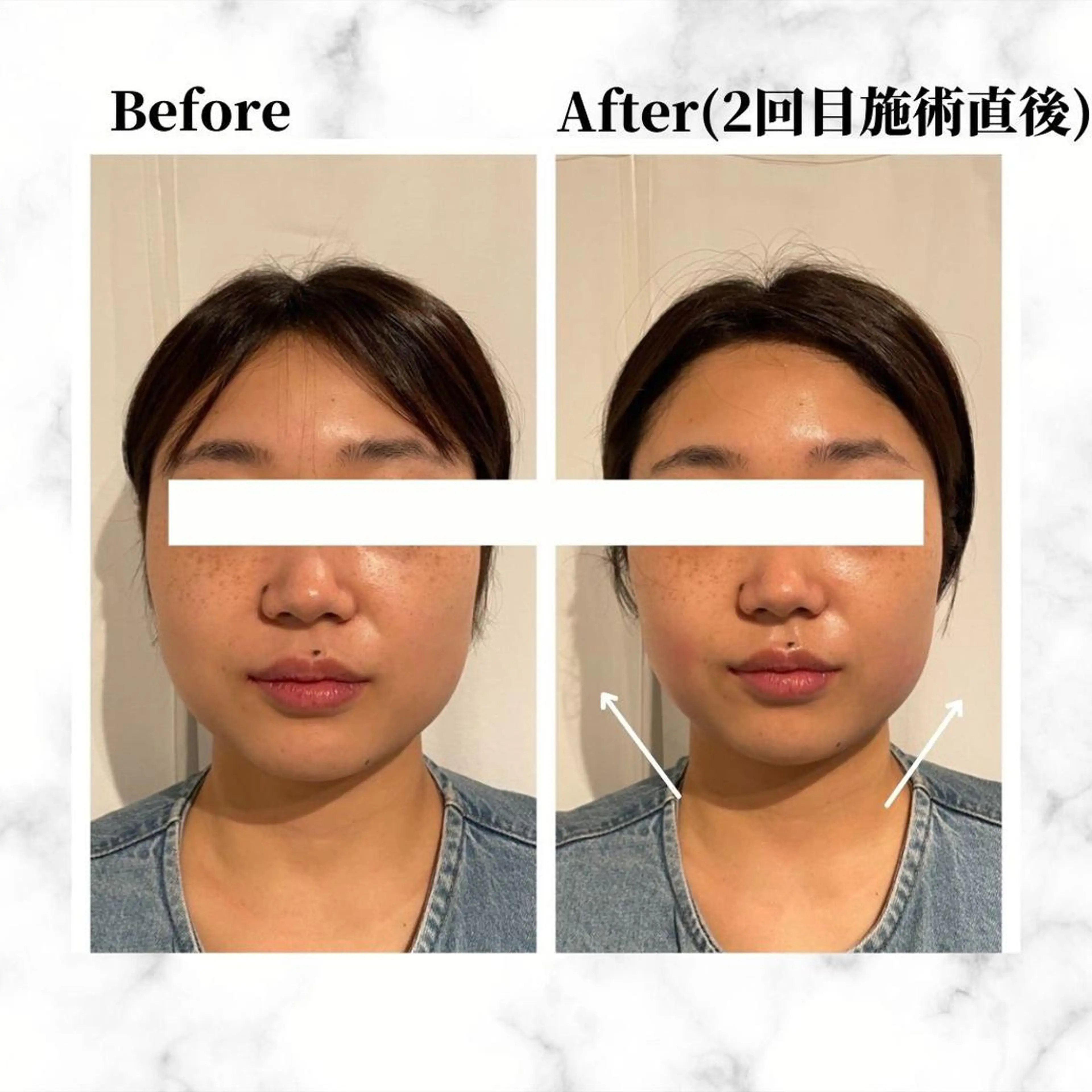 エステ リラク 12Dハイフ💗 最強小顔のエステ・リラクイメージ