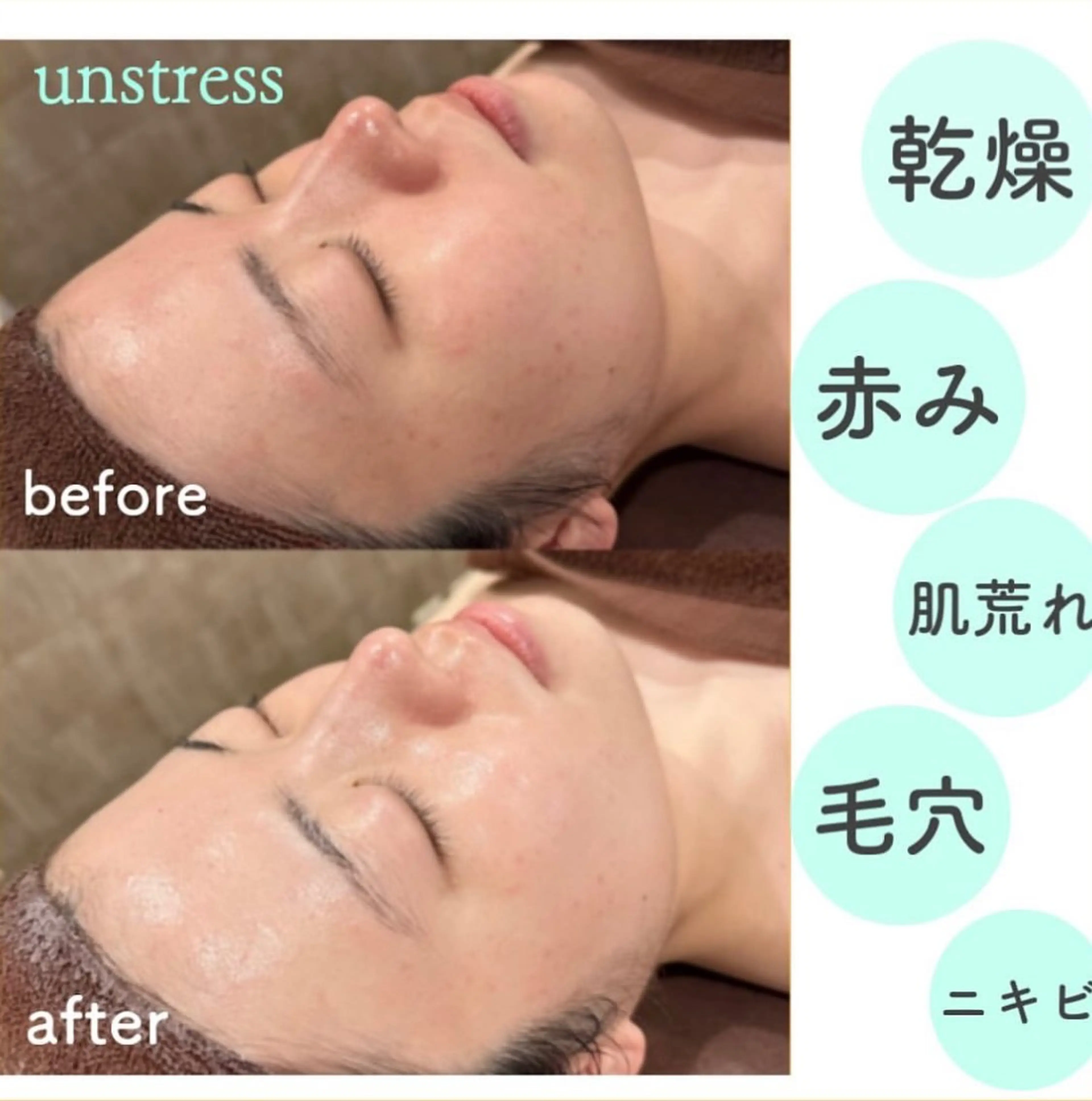 【🌿クリスティーナ/アンストレス🌿】ニキビ・赤み・かゆみ・炎症などを落ち着かせるSOSトリートメント✨の写真