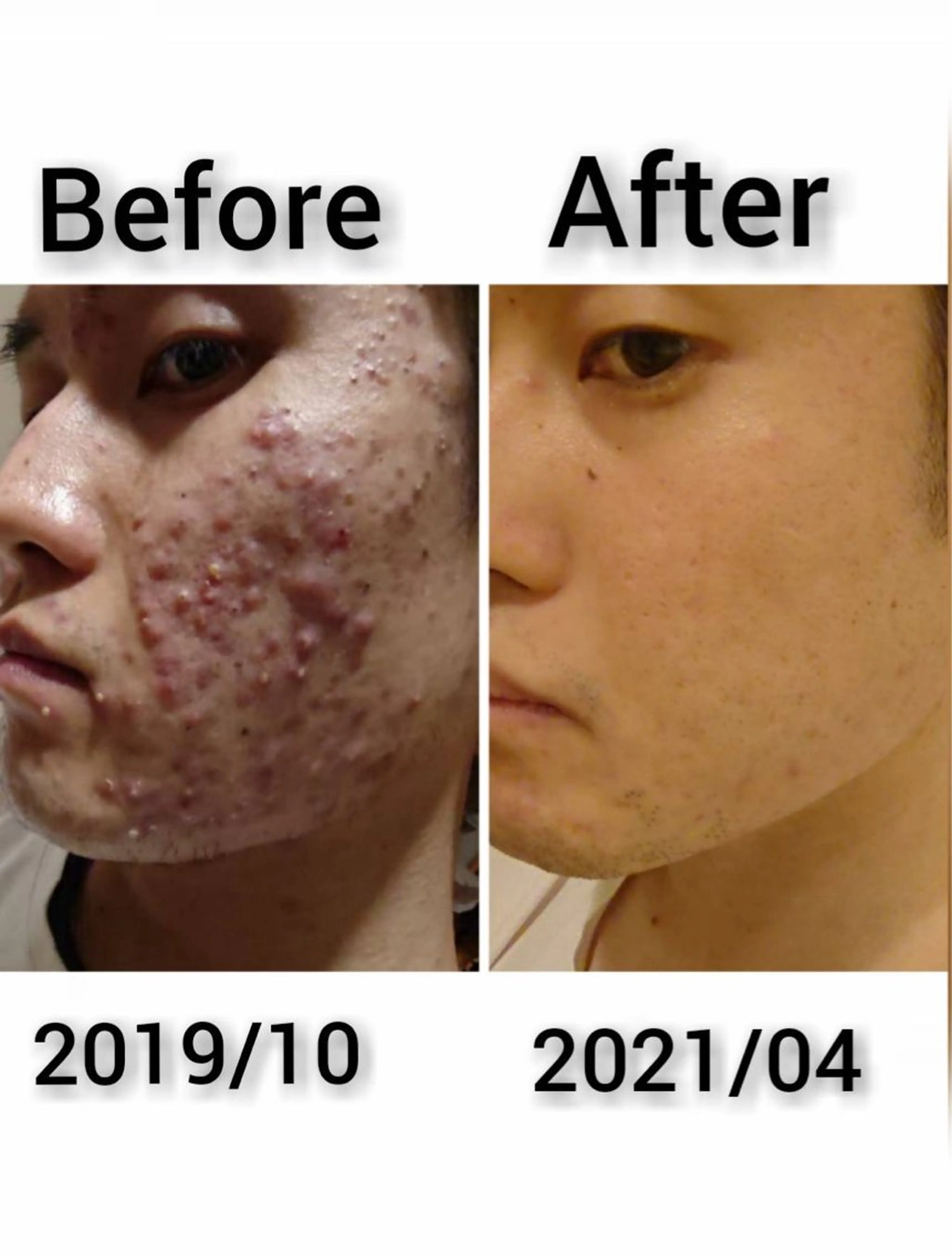 【赤ニキビ改善】 BELL'ET新宿店のエステ・リラクイメージ