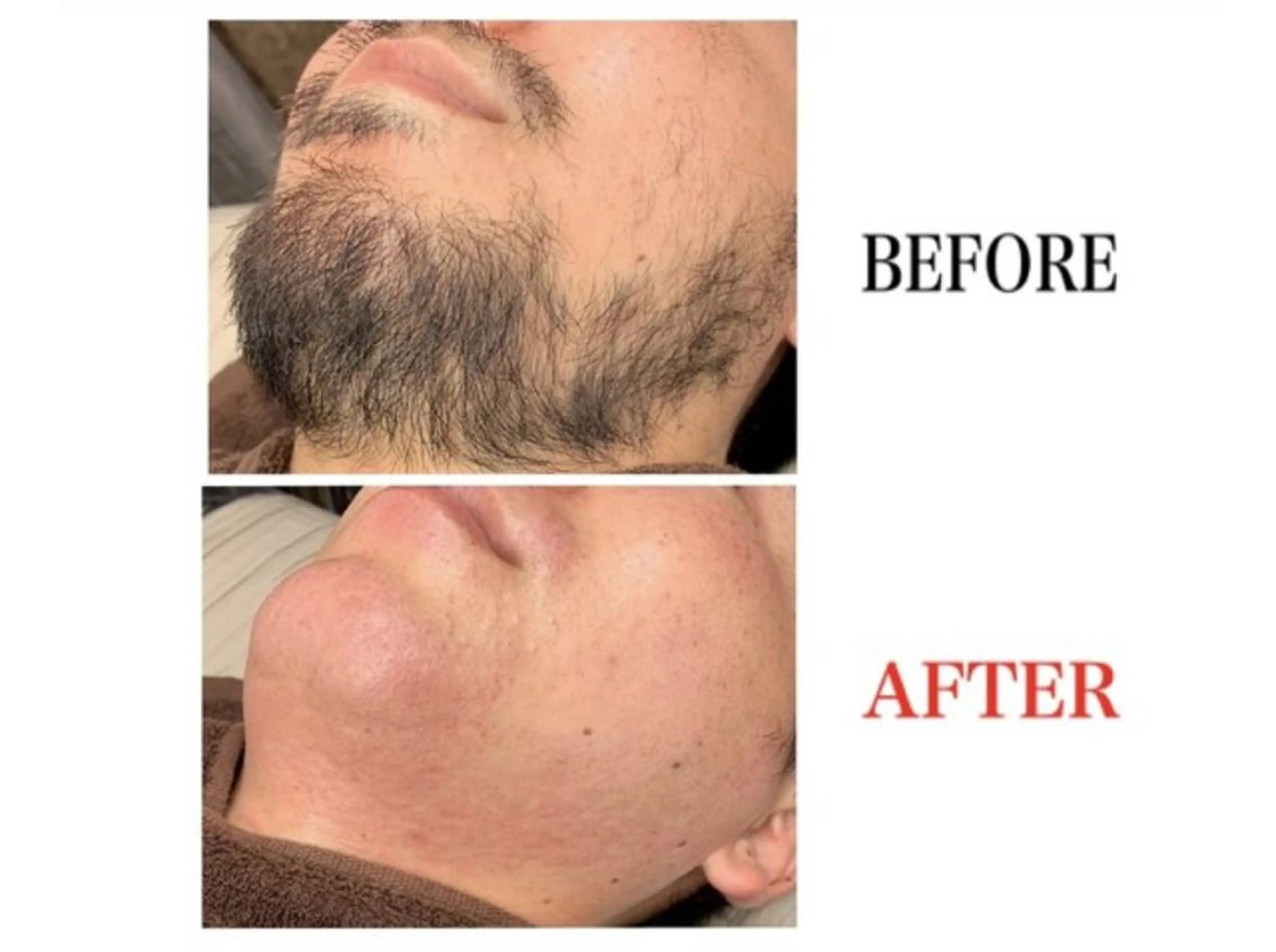 ヒゲワックス脱毛 ★4カ所(鼻下・唇下・あご・あご下)★の写真