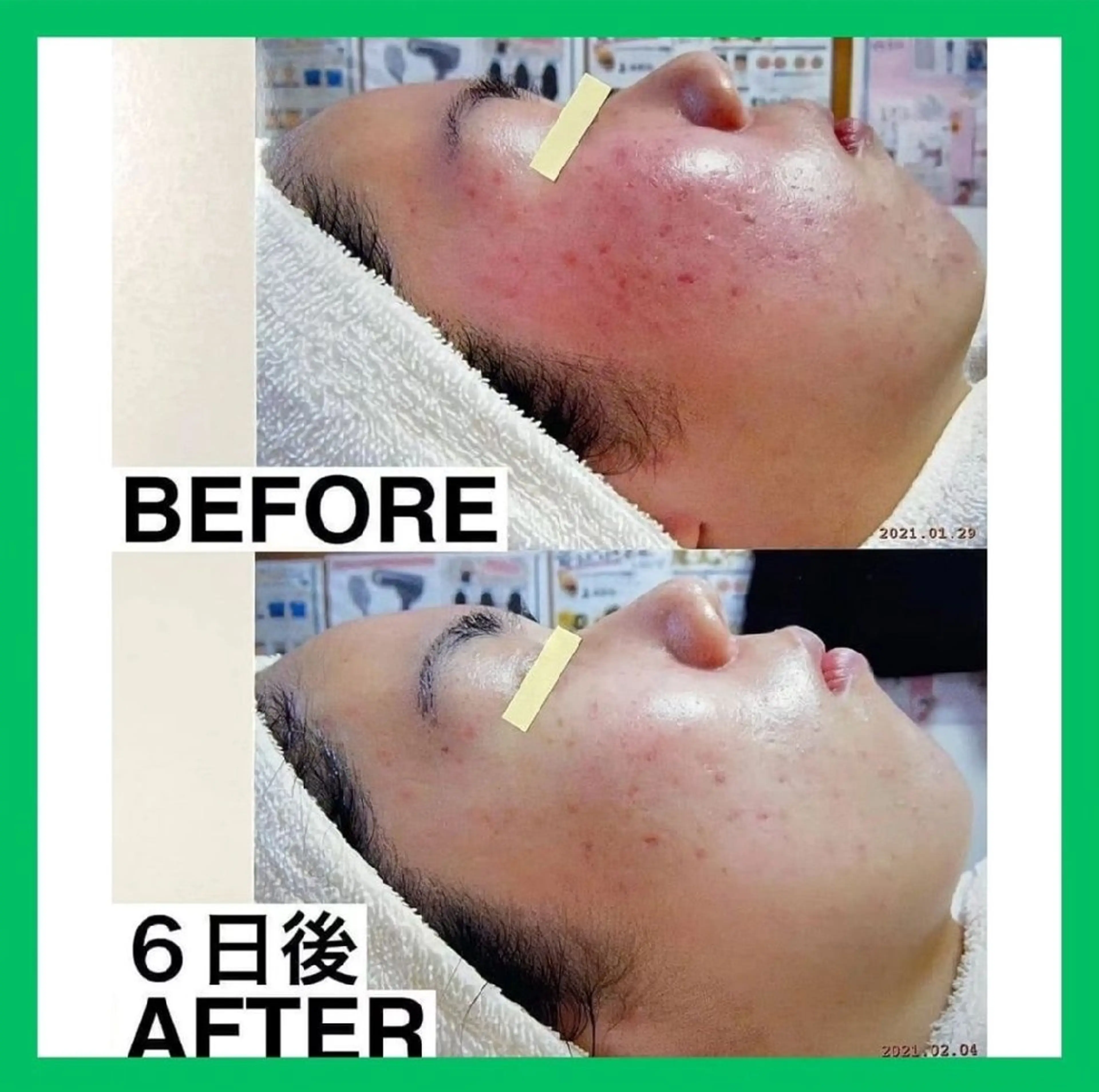 《水分たっぷりツヤ肌に☆憧れの陶器肌へ♪》敏感肌ケア2回体験5,930円✨　[大阪城北詰駅/京橋駅]の写真