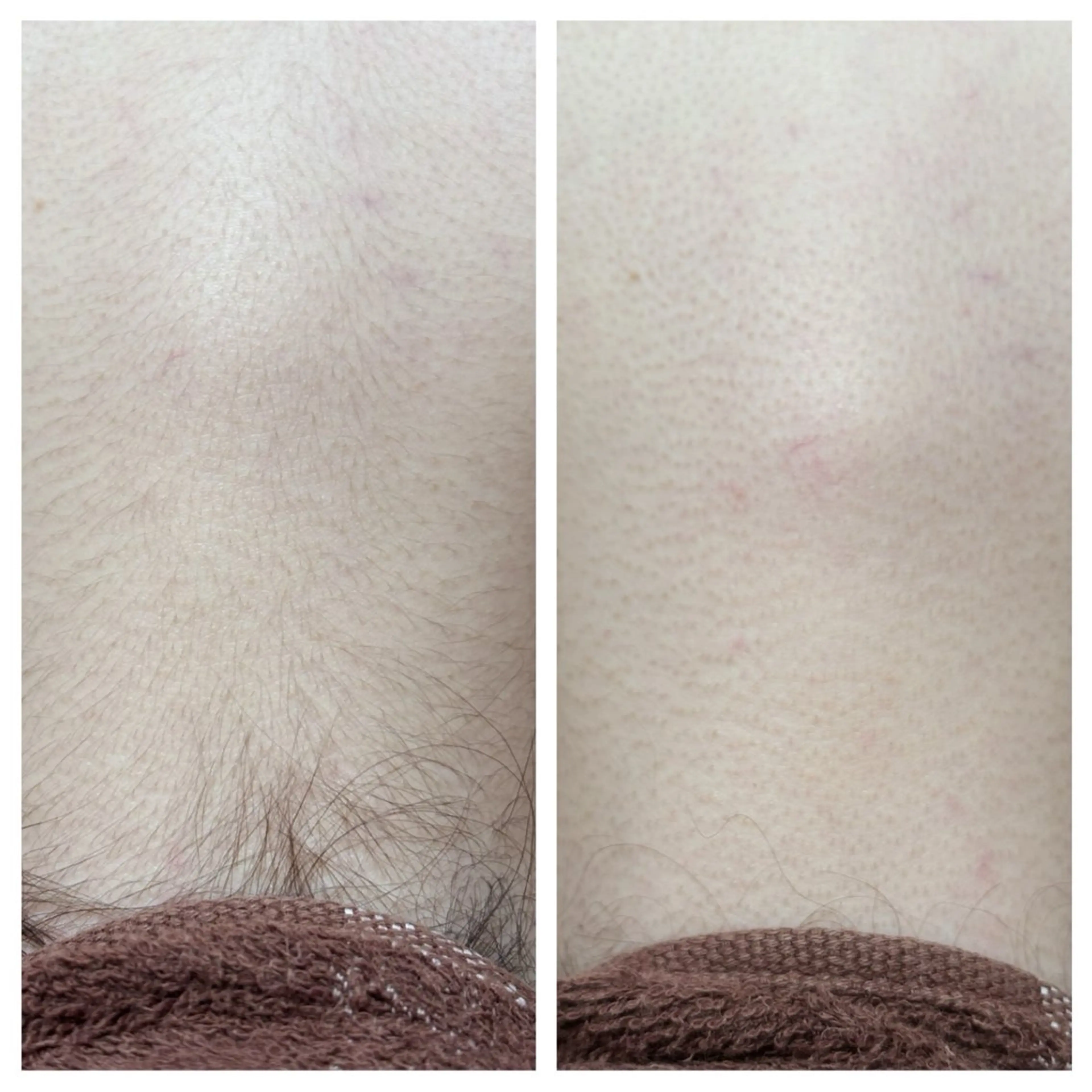 【LED脱毛】全身脱毛（VIO•顔除く）の写真