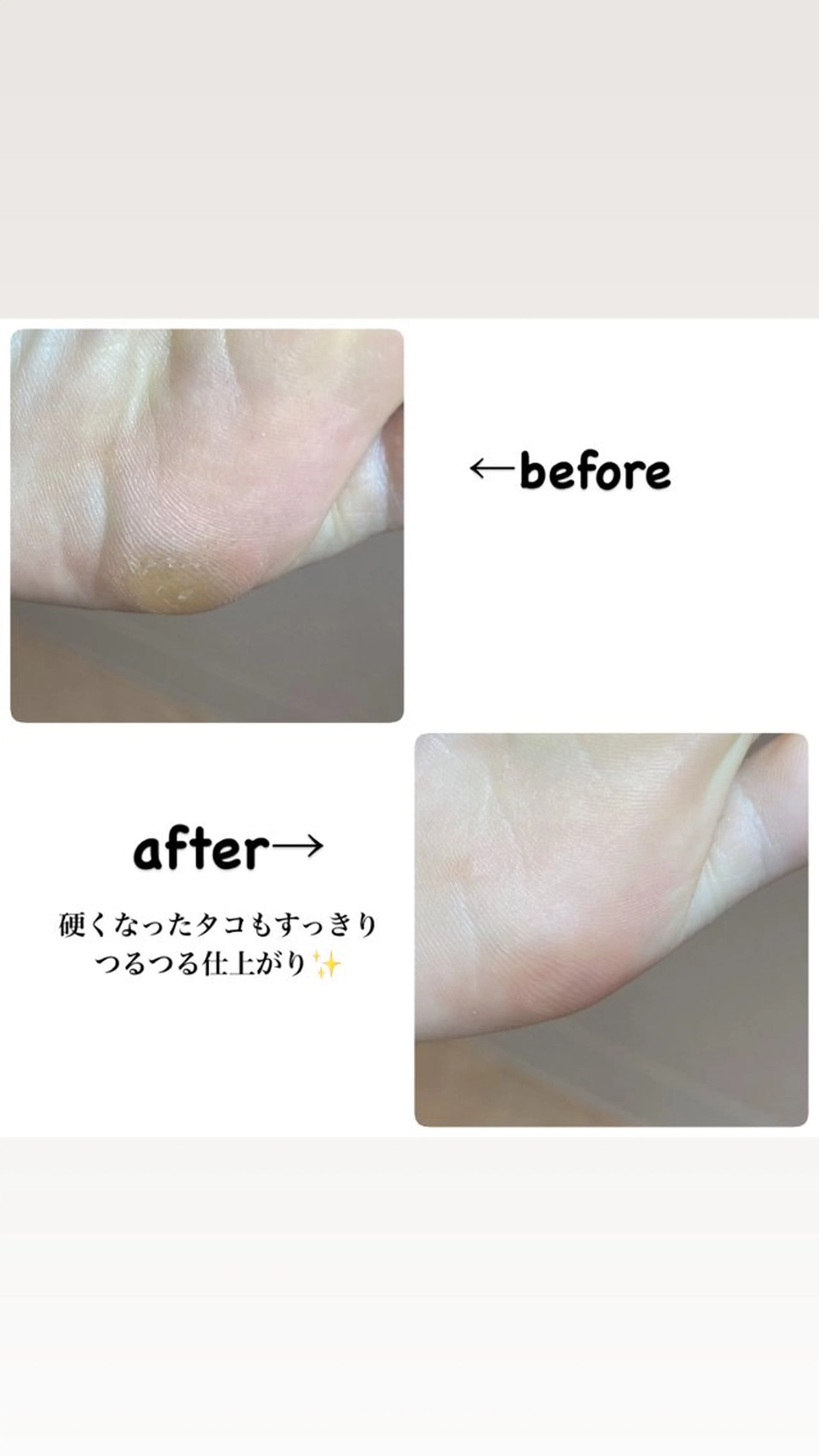 【痛みが少ない＊魚の目・タコ40分ケアコース】1.2箇所や軽めの方向けの写真