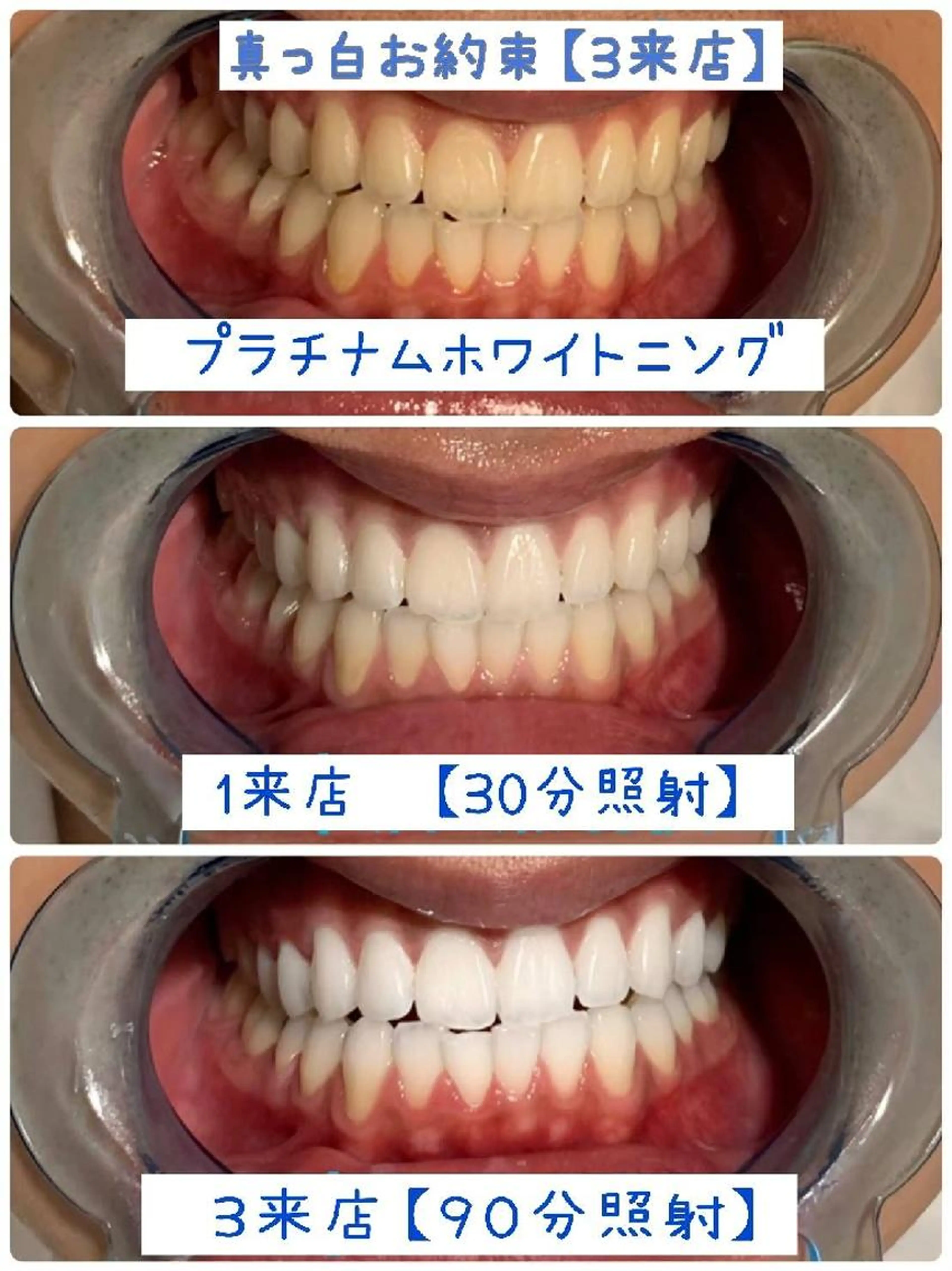 セラミックの様な🦷歯になりたい方はこちら❣✨プラチナムホワイトニングコース✨9照射３来店【🦷本数無制限🦷】の写真