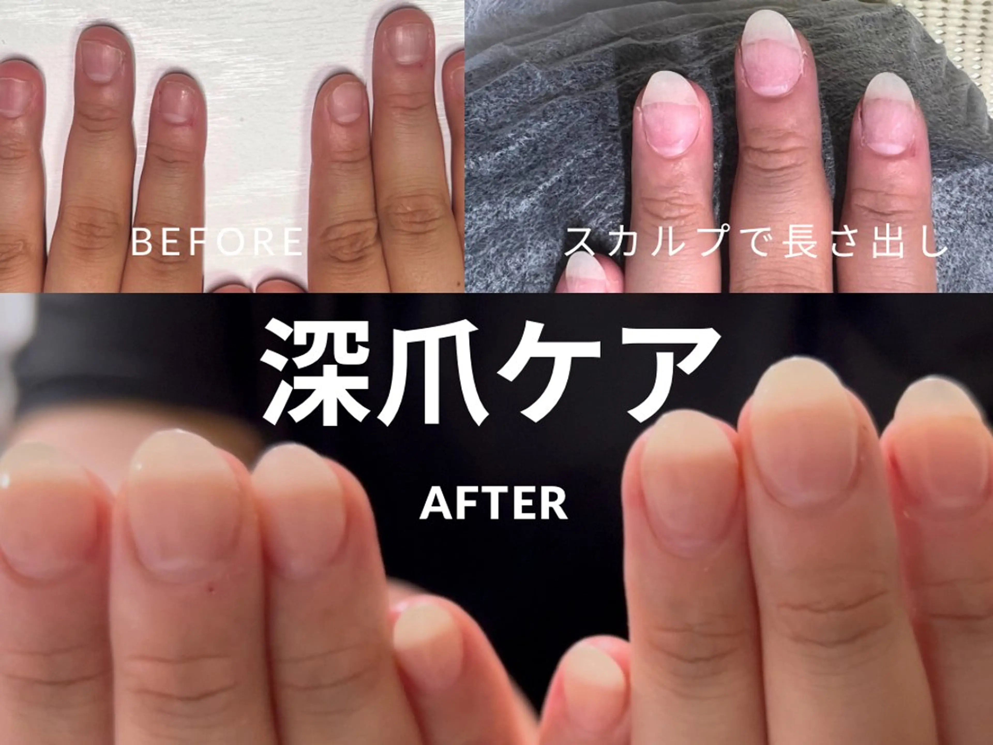 深爪ケア【当日限定/初回】すぐ見た目が変わる/深爪自爪を伸ばしたい方/人工爪で長さ出しクリアor自爪風の写真