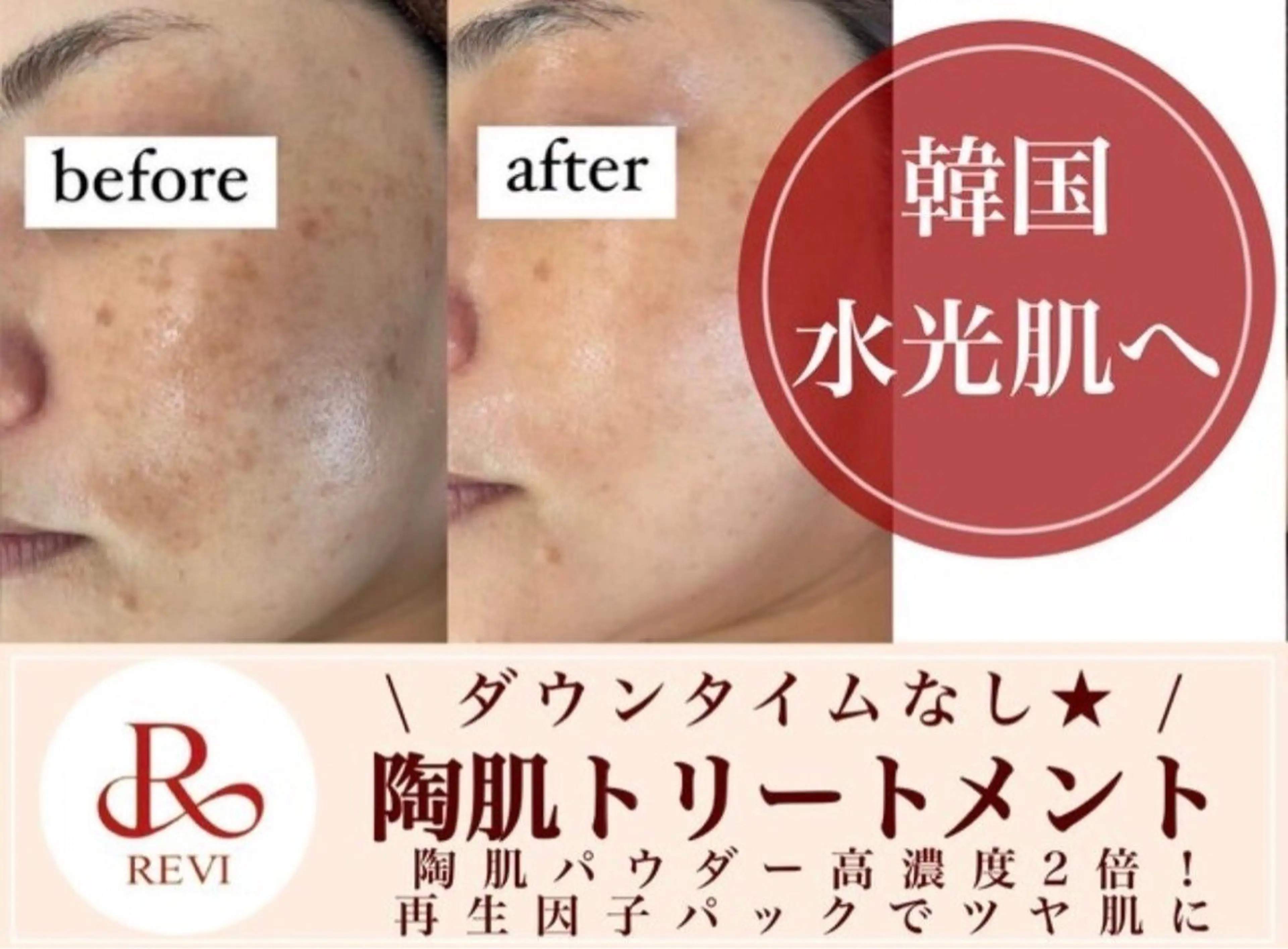 💛とにかくツヤ肌に💛REVIハーブピーリング＋高濃度ビタミンC美容液🍋¥13,000の写真