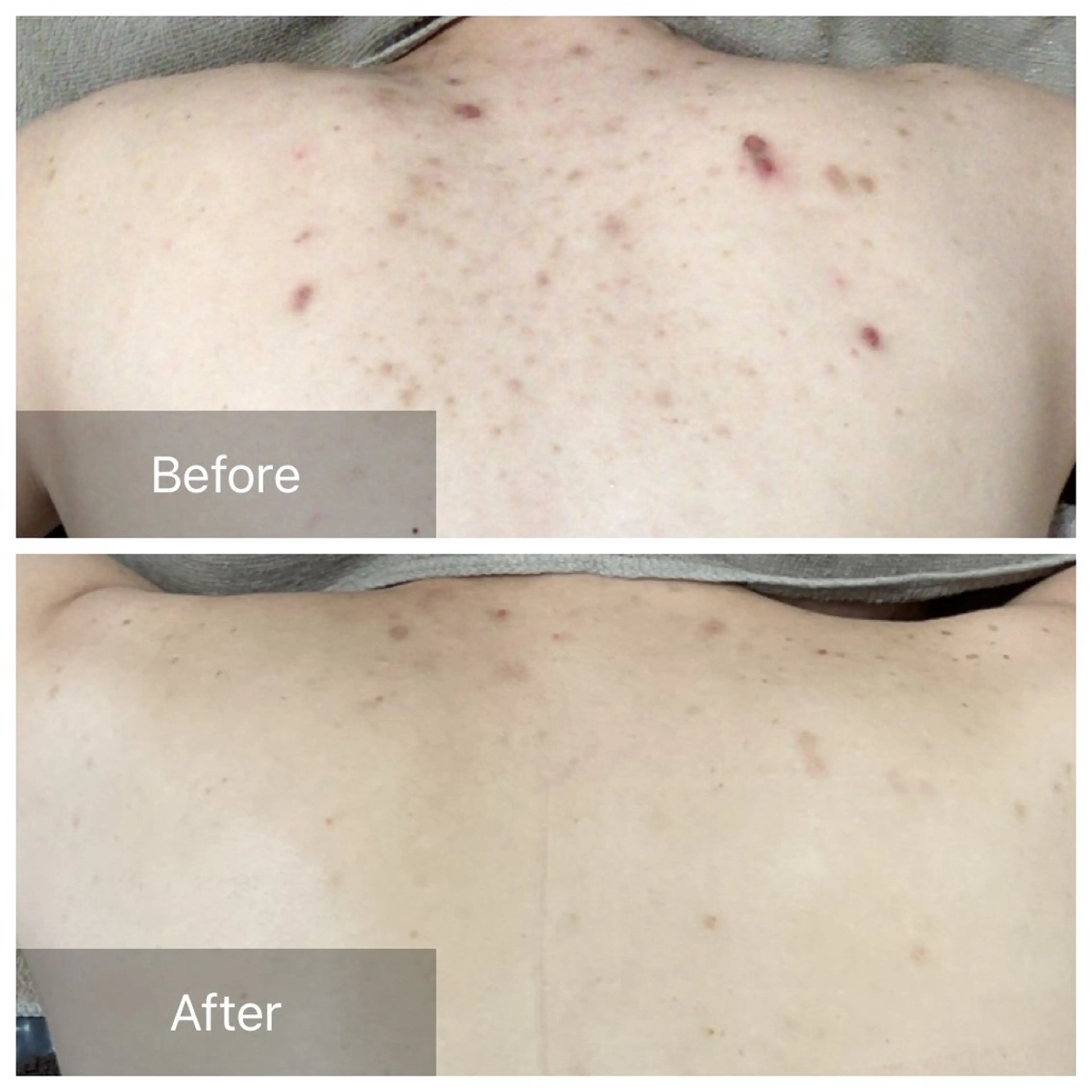 【背中】ハーブピーリング剥離あり/なし選べるの写真