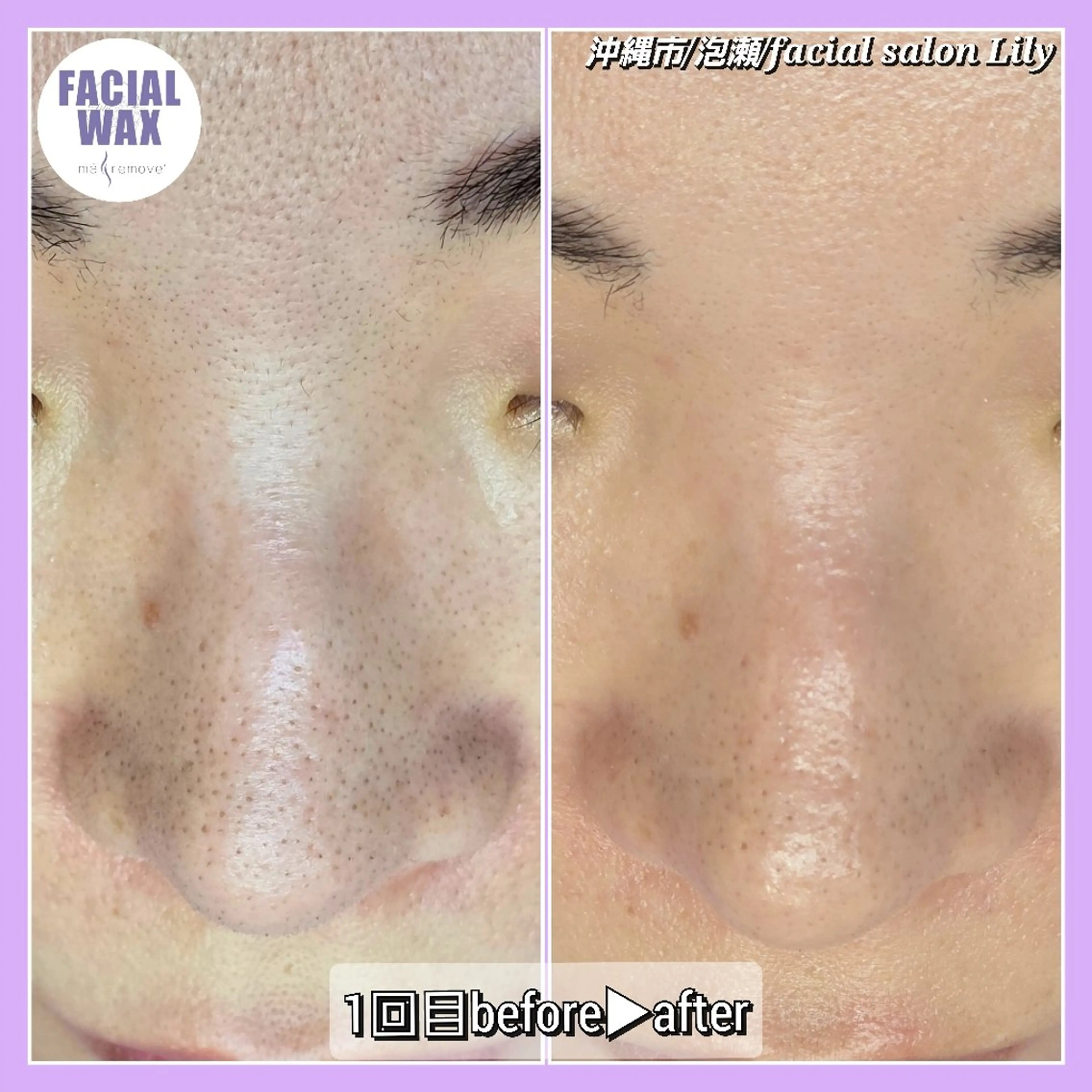 脱毛 facial salon Lily所属・salon Lilyのエステ・リラクイメージ