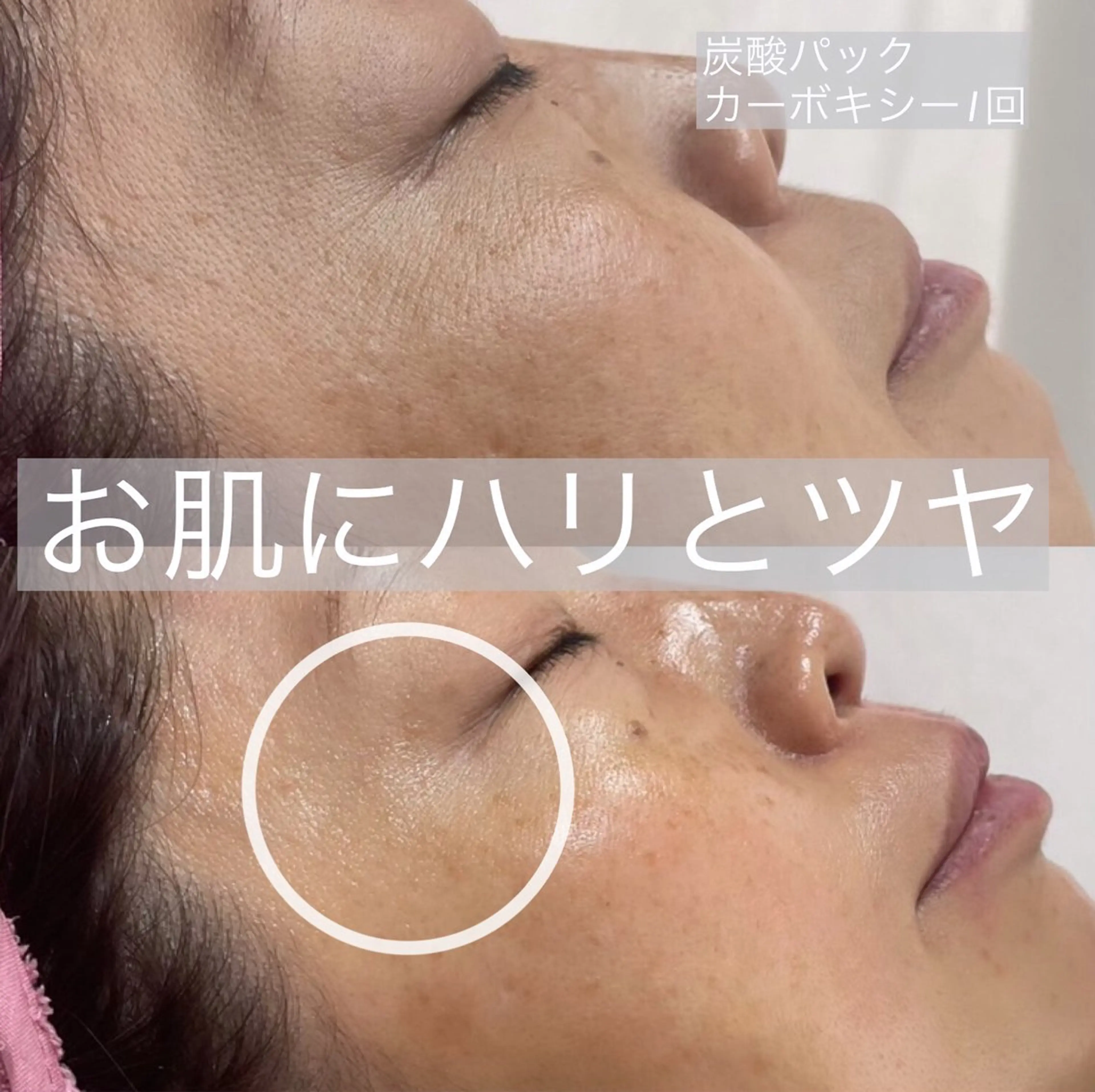 つるつるお肌と小顔!バンテージ炭酸ガスパックカーボキシーとフェイシャルワックスのダブルメニュー(ヘッドマッサージ付き)の写真