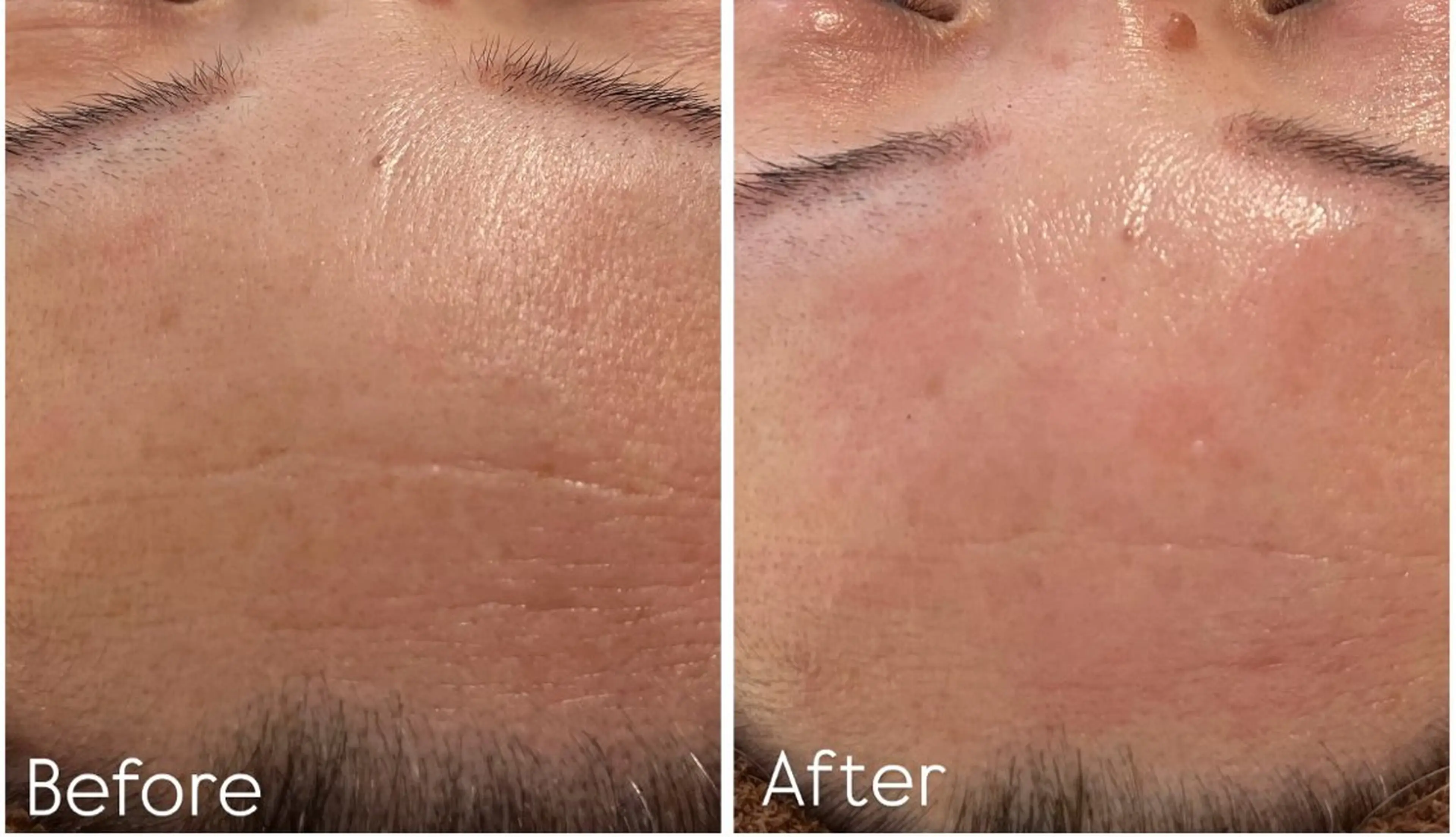 REVIハーブピーリング🌿【シワ・たるみ集中ケア】の写真