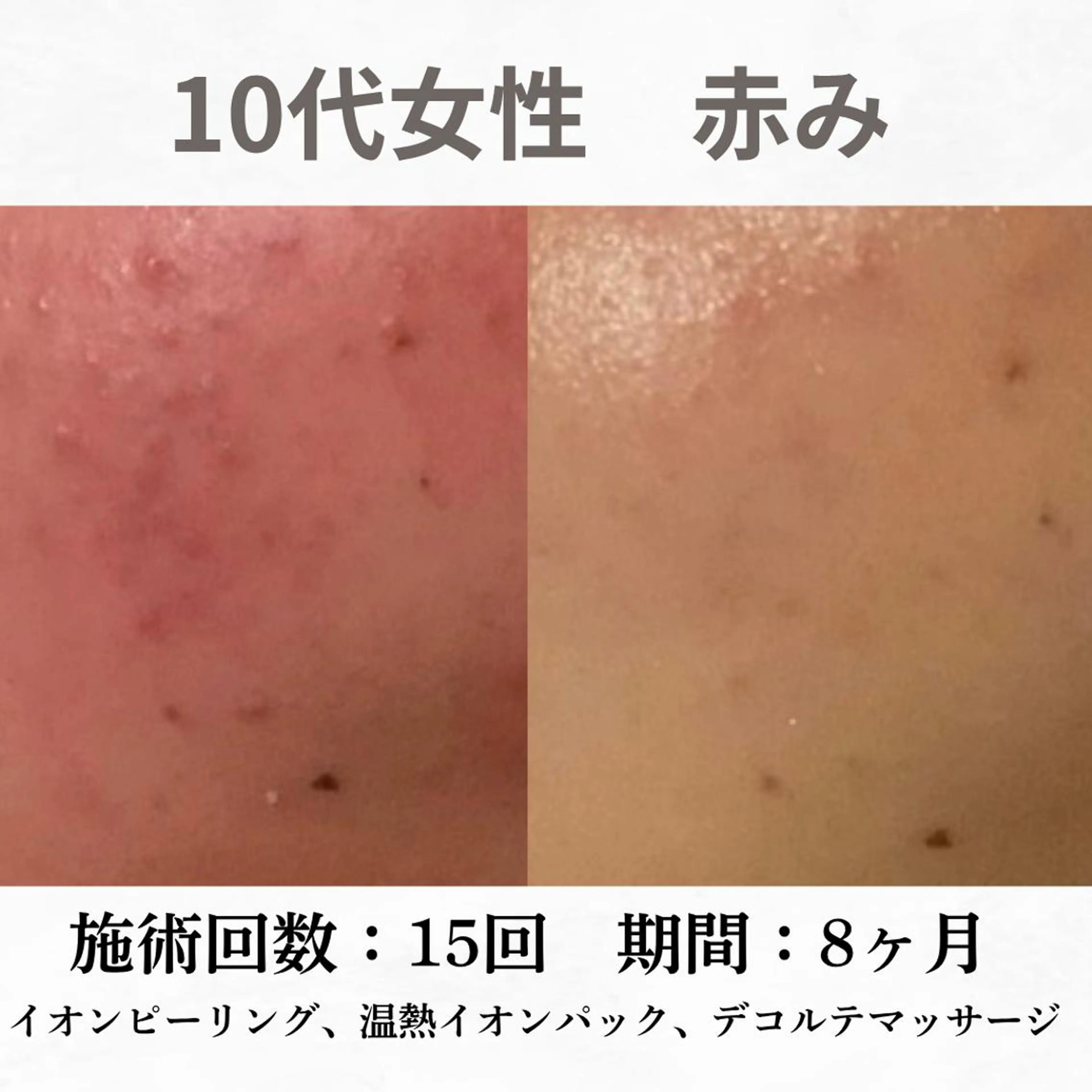 重度ニキビ専門🌷 ダウンタイムなしのエステ・リラクイメージ