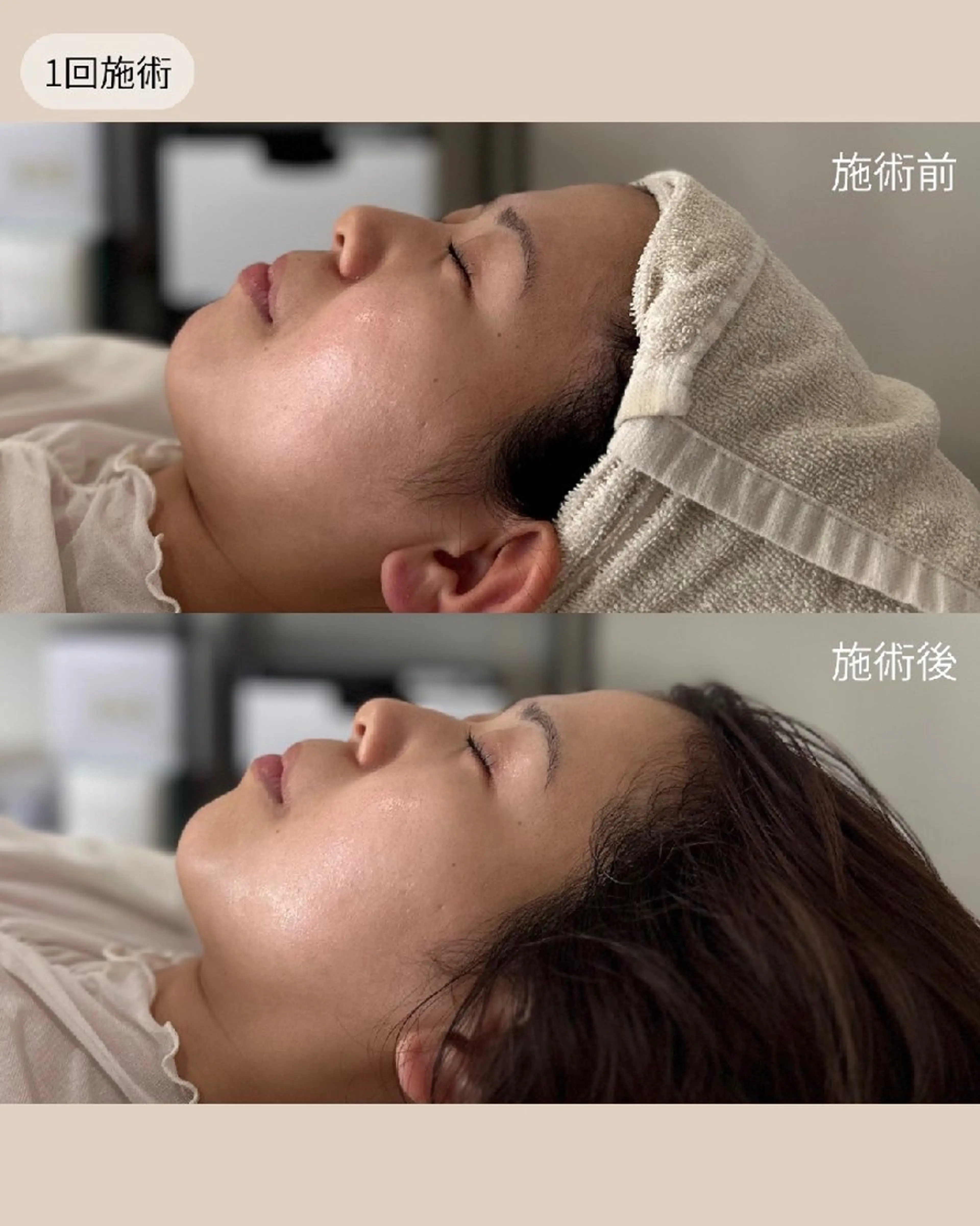 🧹毛穴脱退！ハイドロスプラッシュ《全顔》フケや臭いの原因になるのを防ぐ"頭皮ケア付"✨️の写真