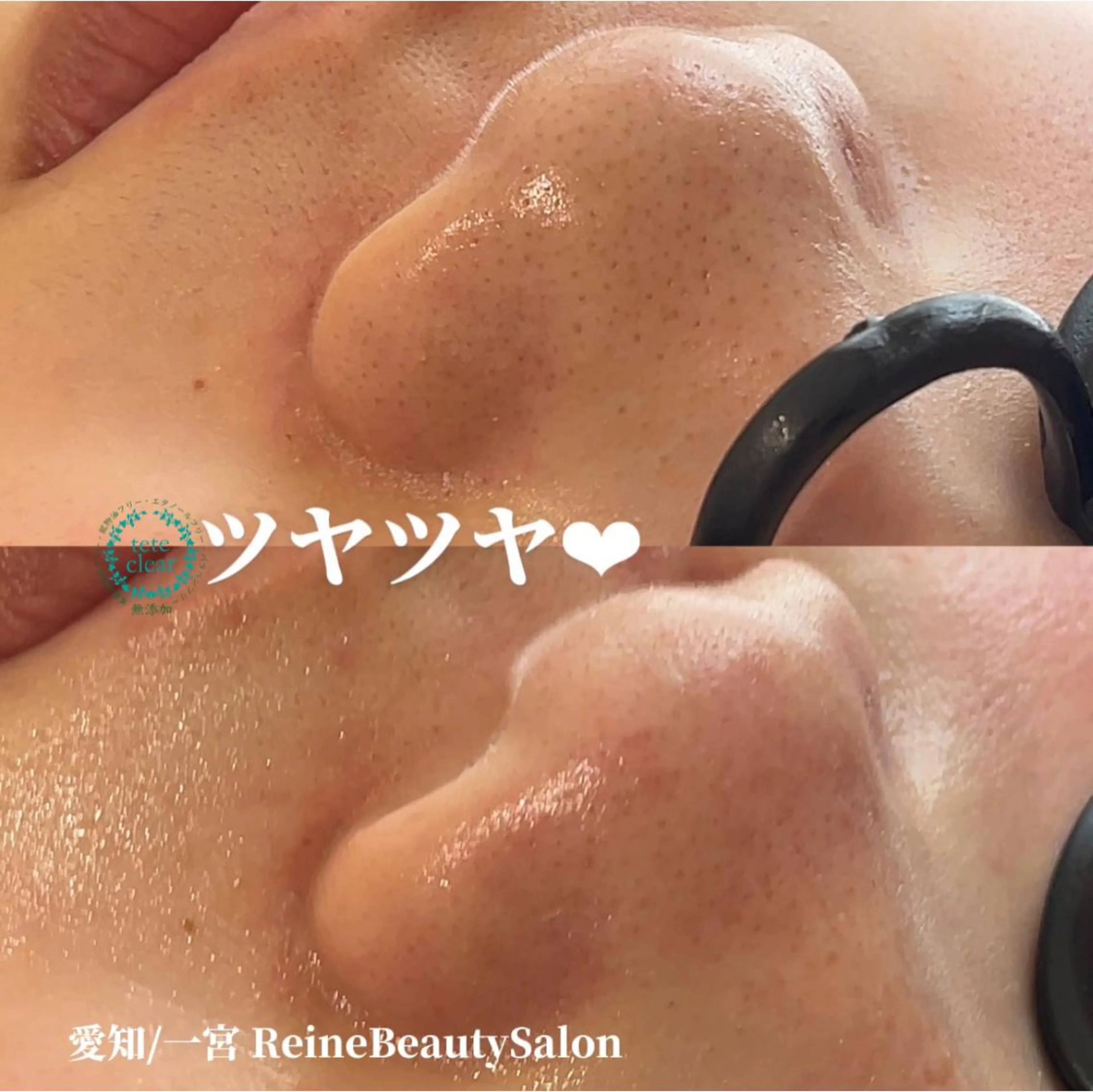 エステ Reine BeautySalon所属・毛穴/シミ肝斑/脱毛 横山梨里のエステ・リラクイメージ