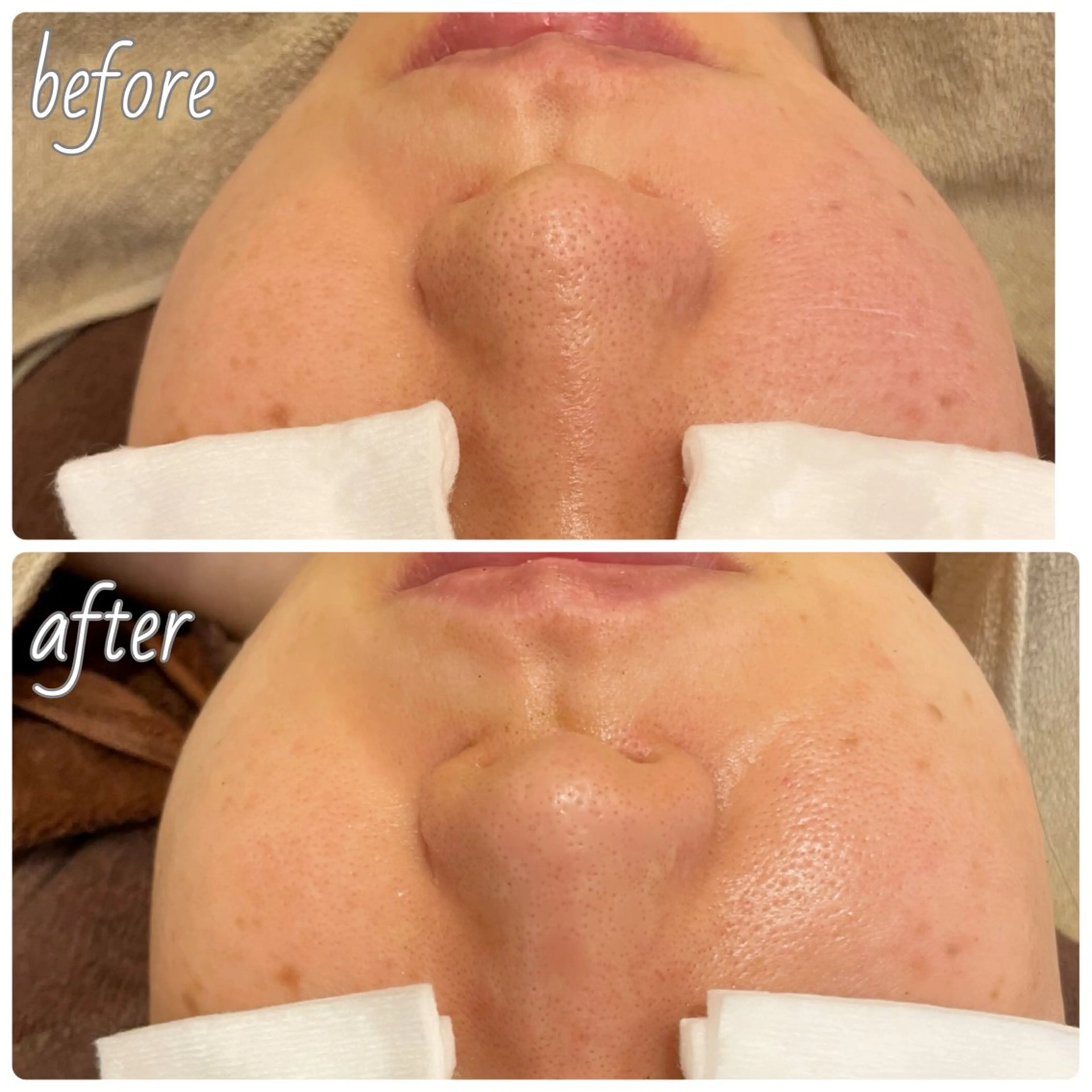 Belsia千歳烏山 ピーリング＆眉毛のエステ・リラクイメージ