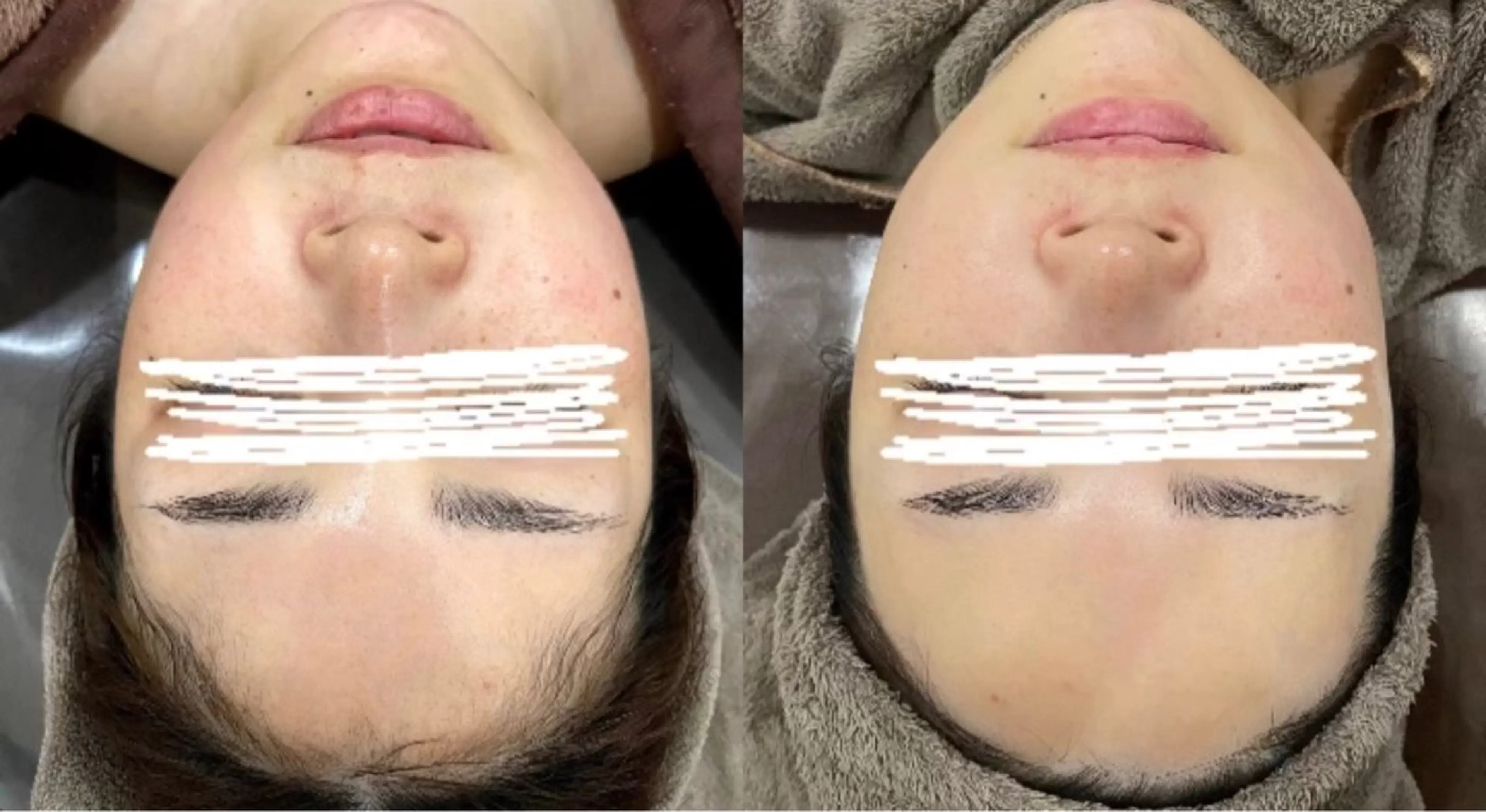 ミニモ限定😳💗　脱毛（1箇所）＋超浸透美容液導入フェイシャル🔥化粧ノリアップ✨肌トラブルケア🌷の写真