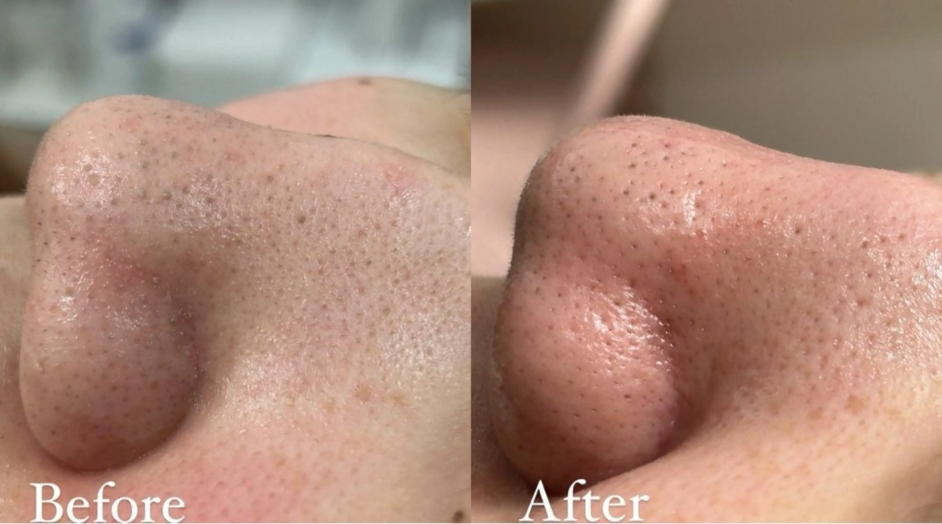 💆🏻‍♀️ハイドラフェイシャル💆🏻‍♀️の写真