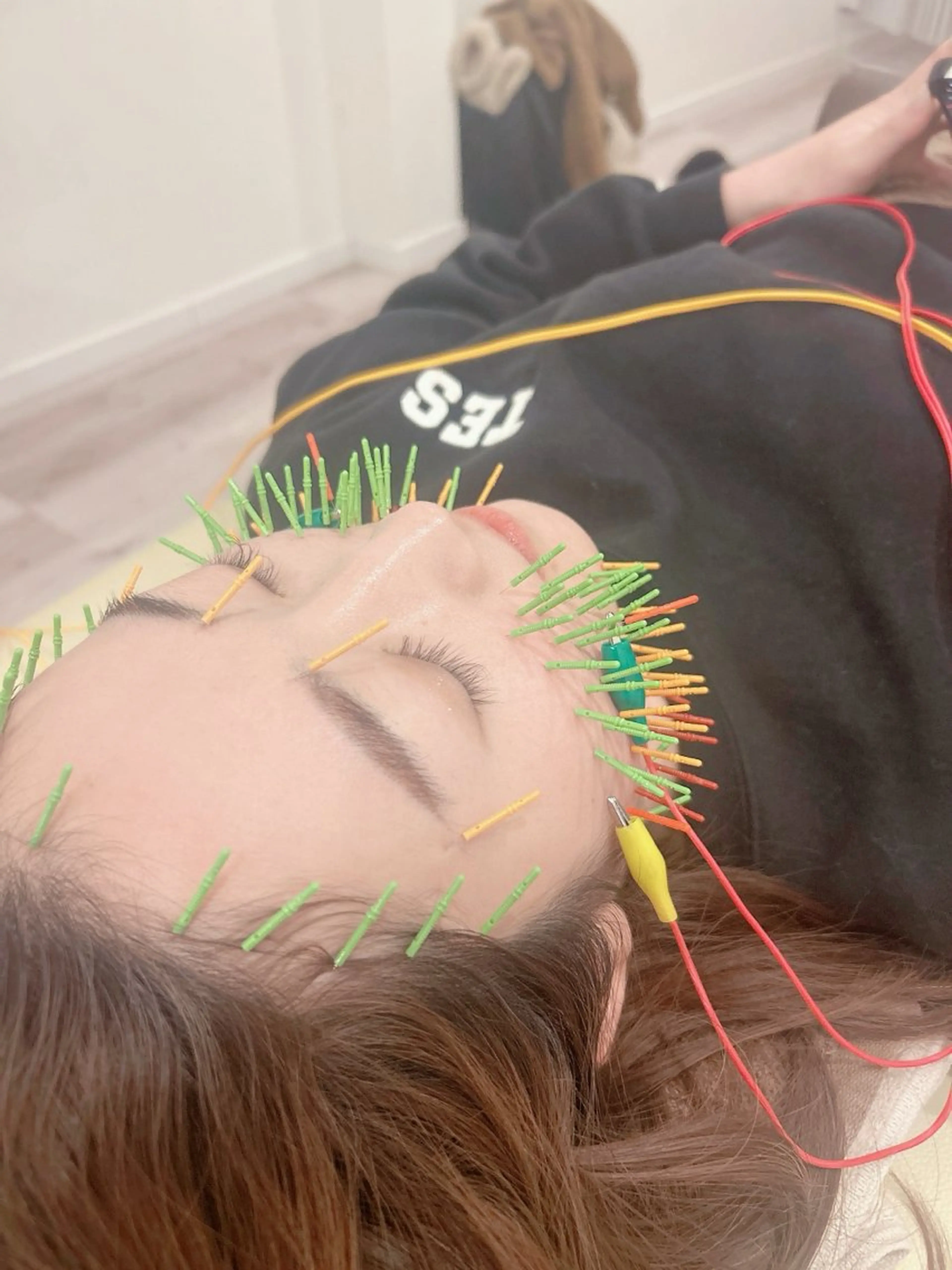 エステ リラク 美容鍼灸Solana所属・肌質改善×美容鍼 ゆいのエステ・リラクイメージ