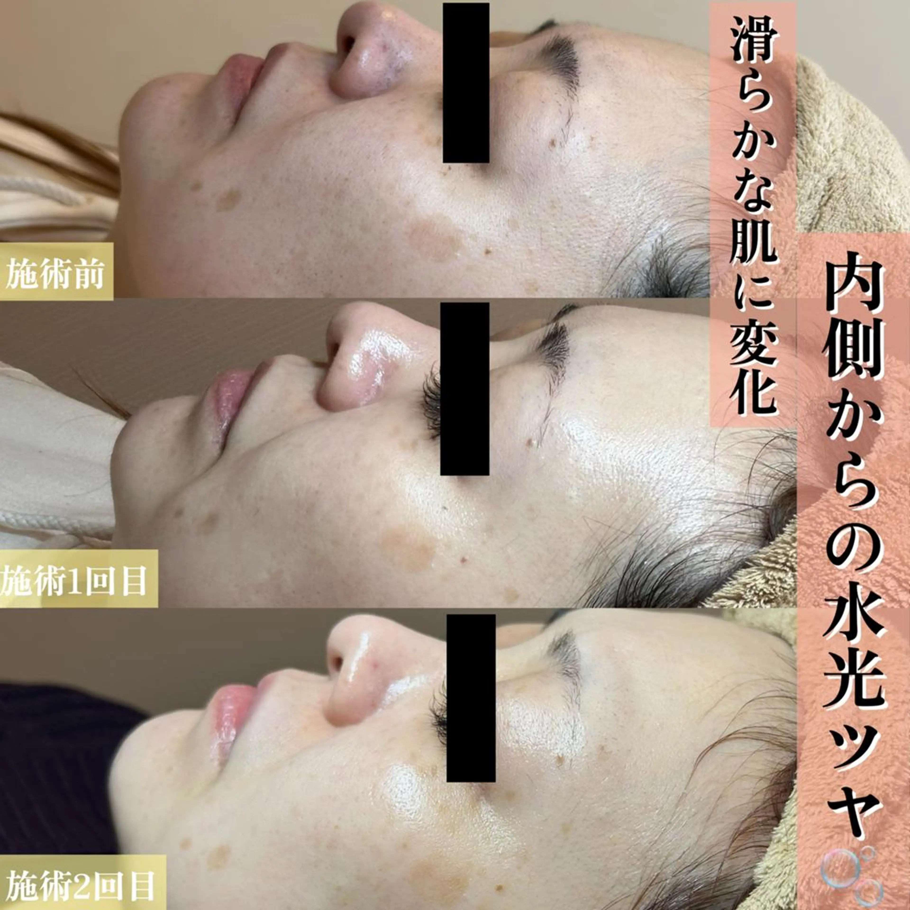 【半額クーポン】ハイドラ+スノーピーリングの写真