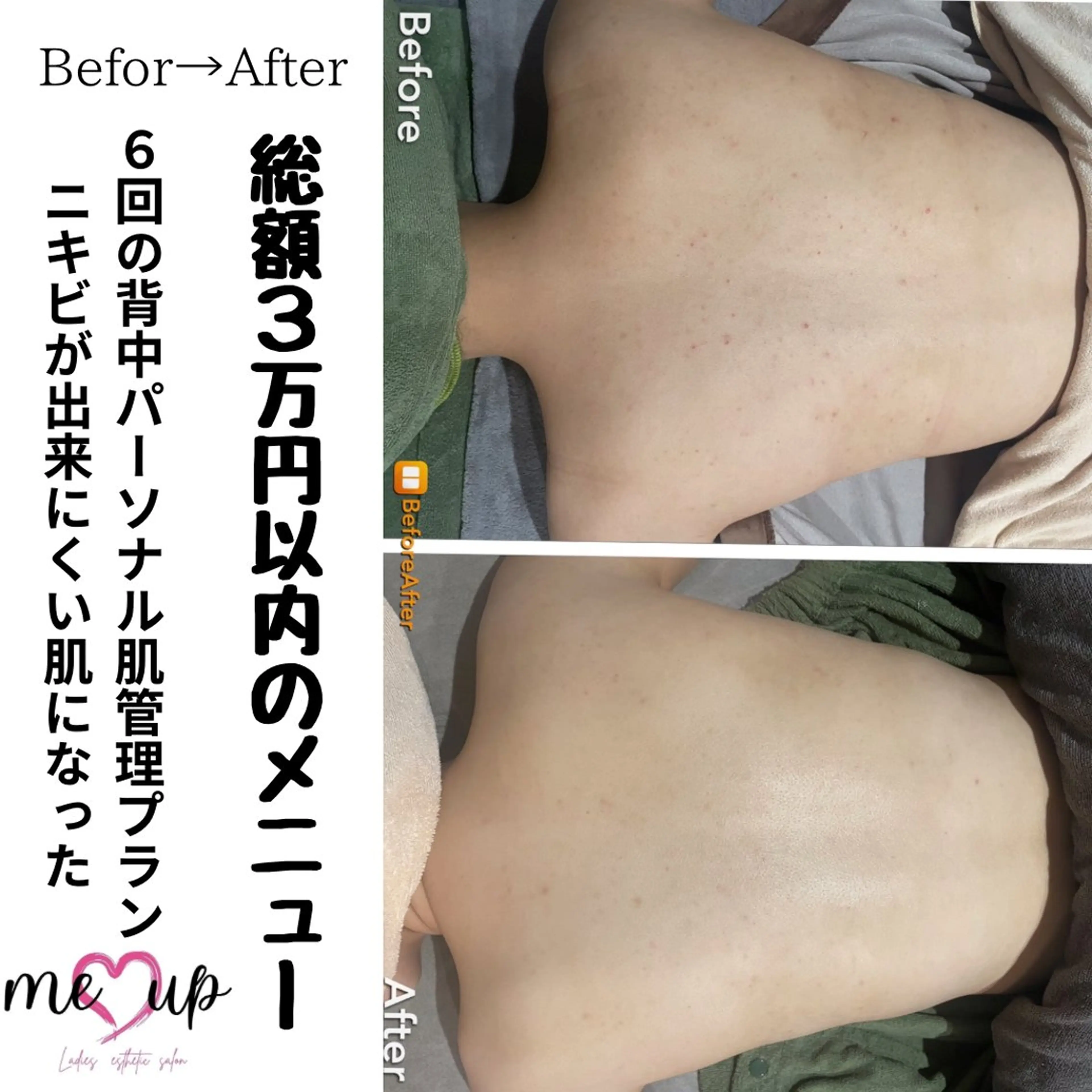 エステ Meupニキビ専門店 背中/ハーブ/肌管理のその他イメージ