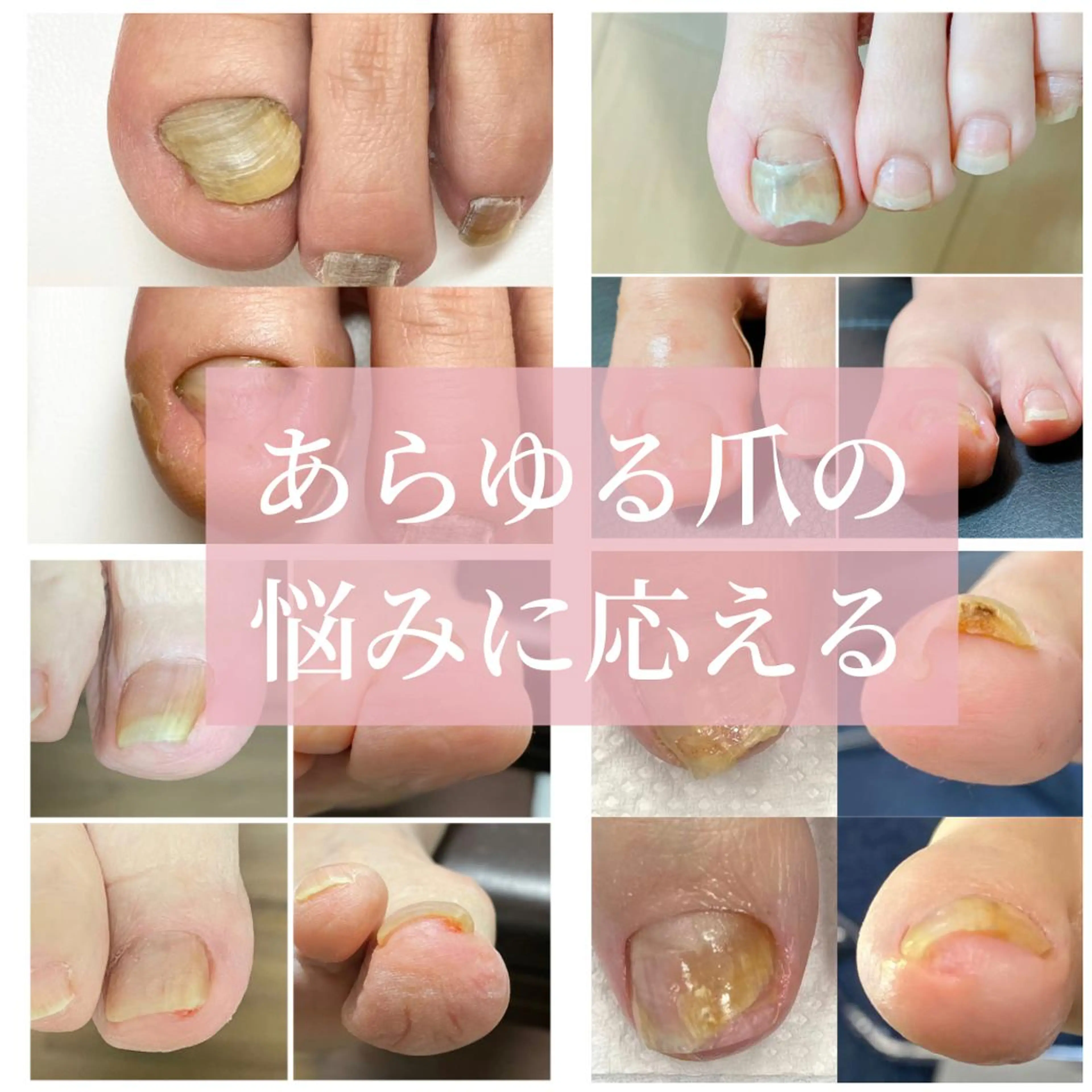 ネイル 深爪・巻き爪 専門サンセリテのネイルデザイン