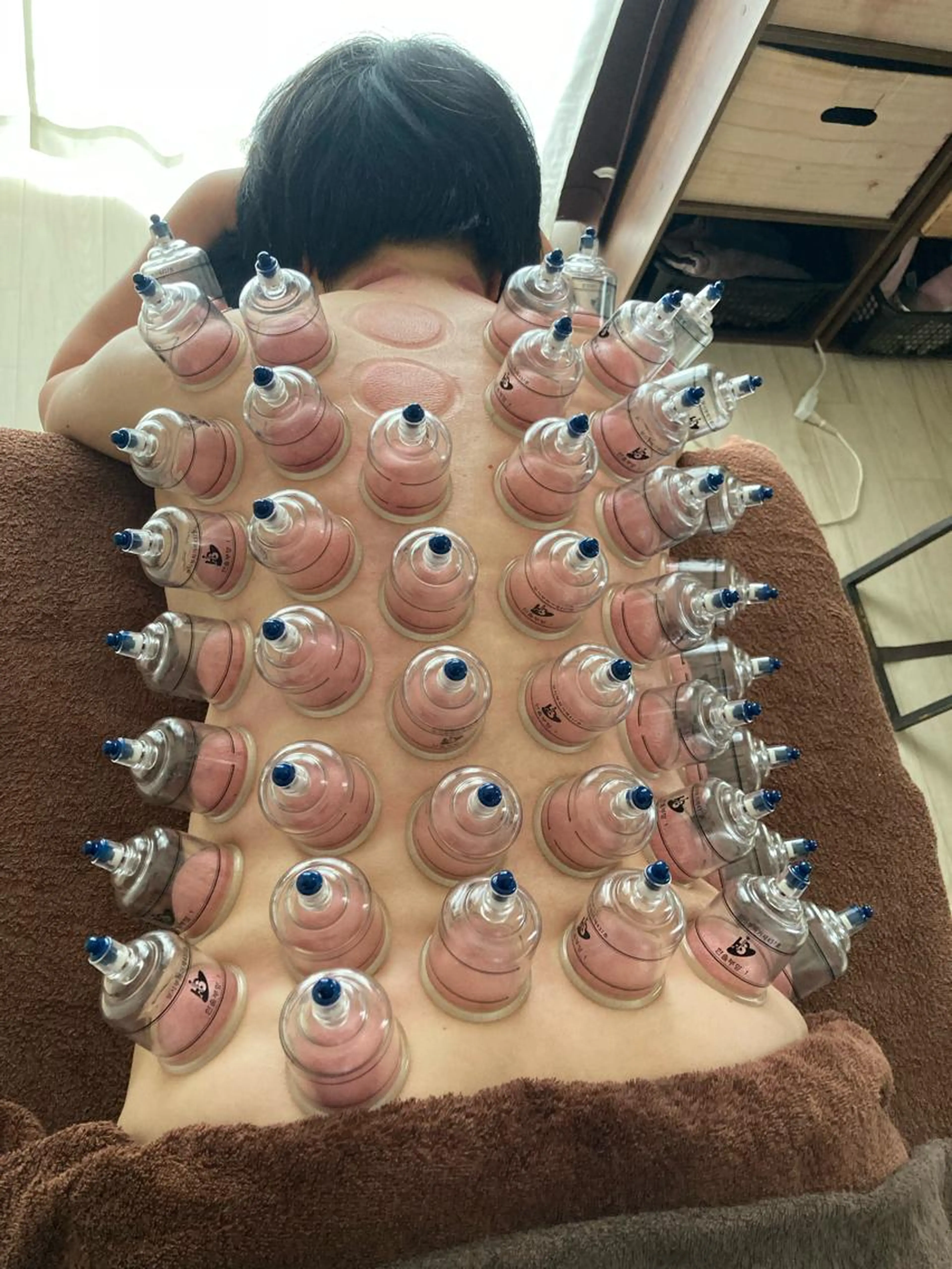 背面全身カッピングの写真