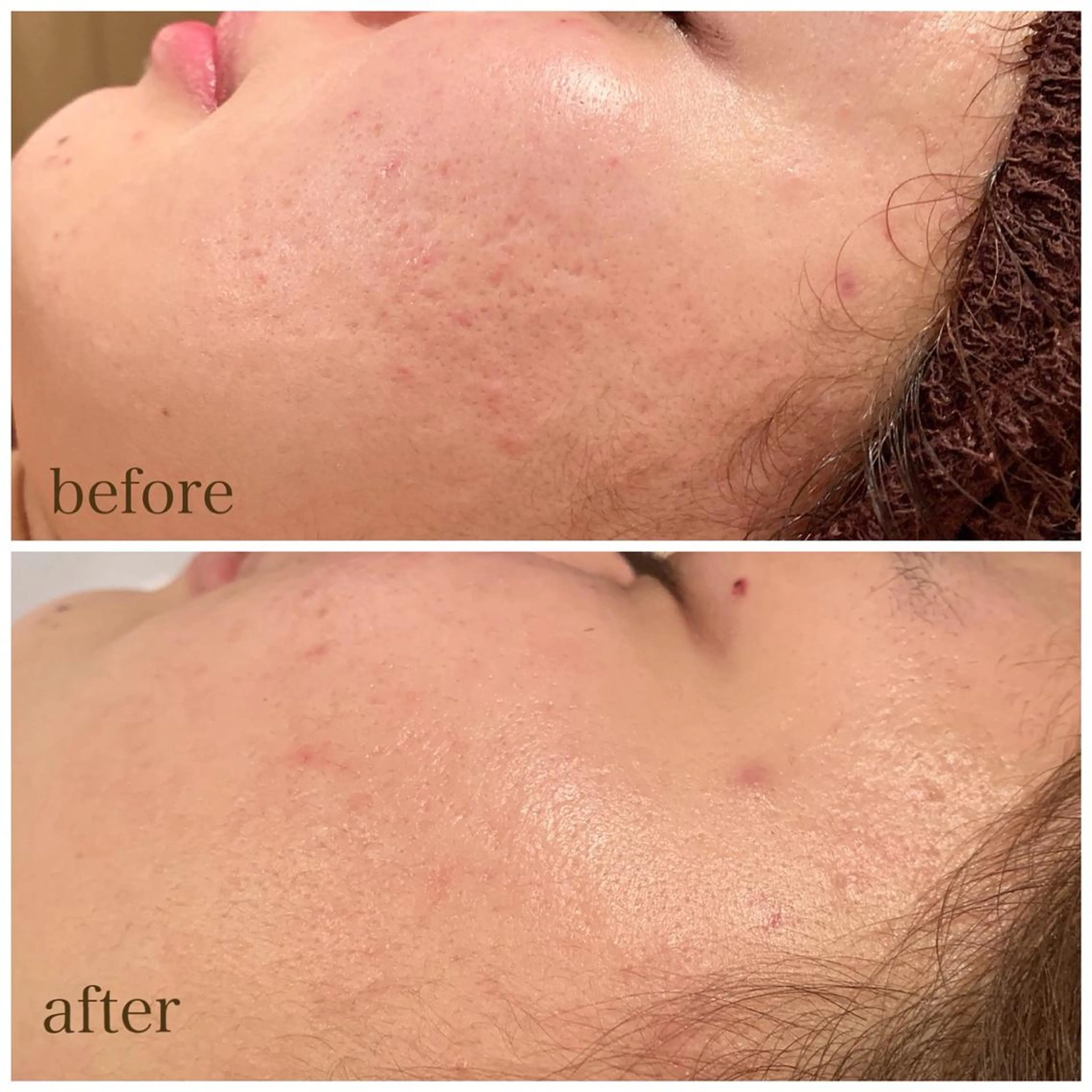 剥けない痛くないのに効果抜群❣️ハーブピーリング✳︎【軽度​〜​中度】1.5g🌿の写真