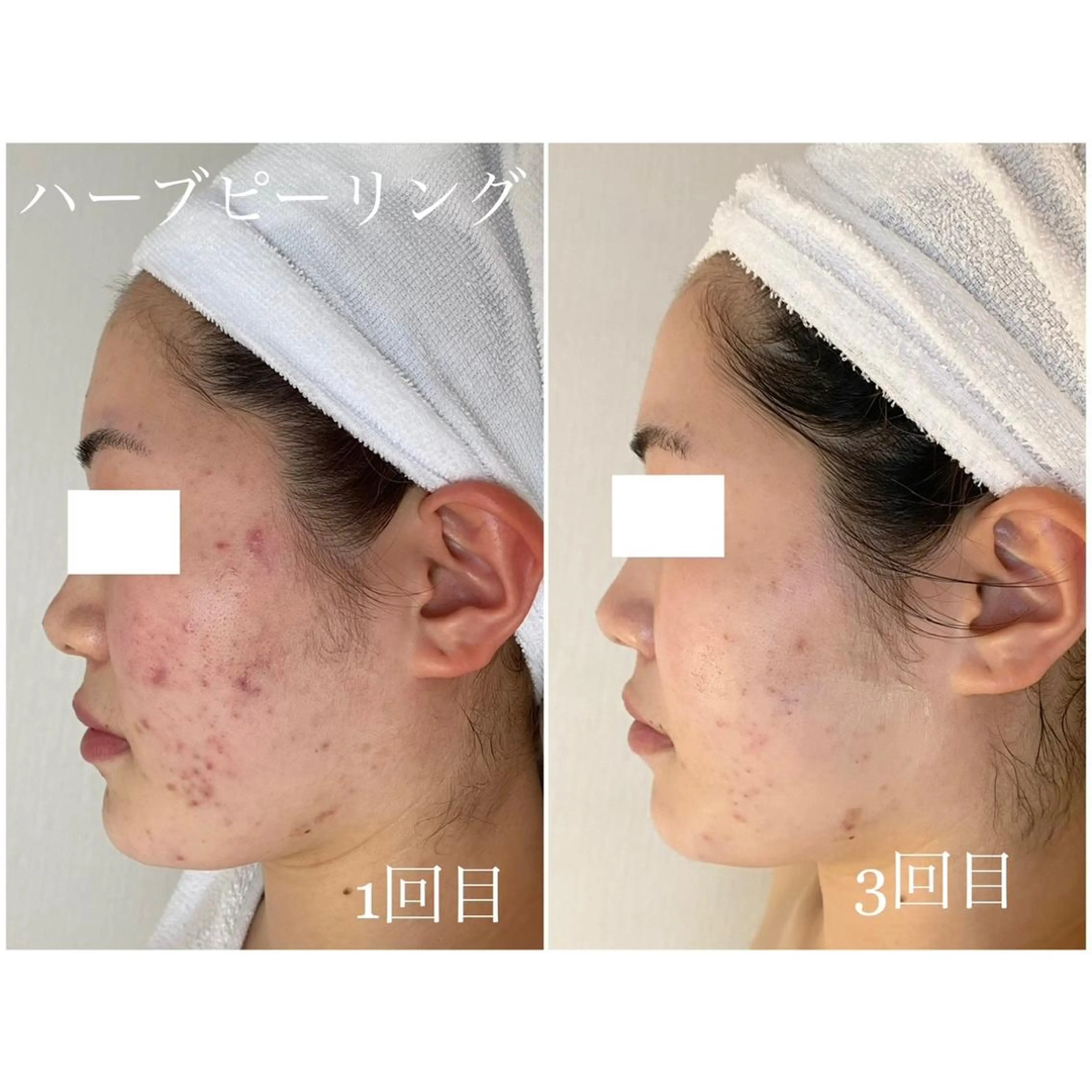 I'm -ｲﾑ-所属・肌質改善／ブライダル I'm.-イム-のエステ・リラクイメージ