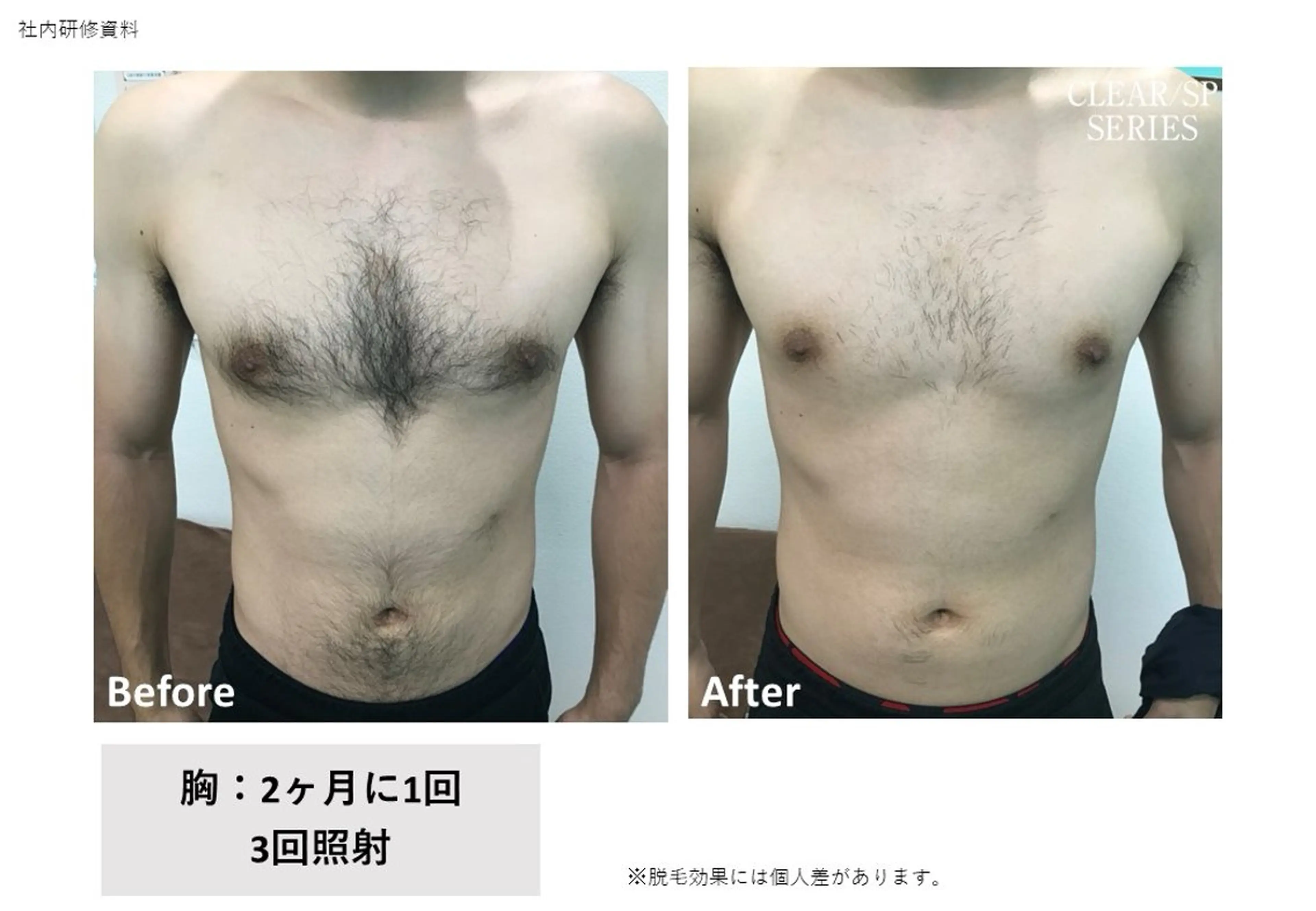 脱毛 VIERU YURIのネイルデザイン