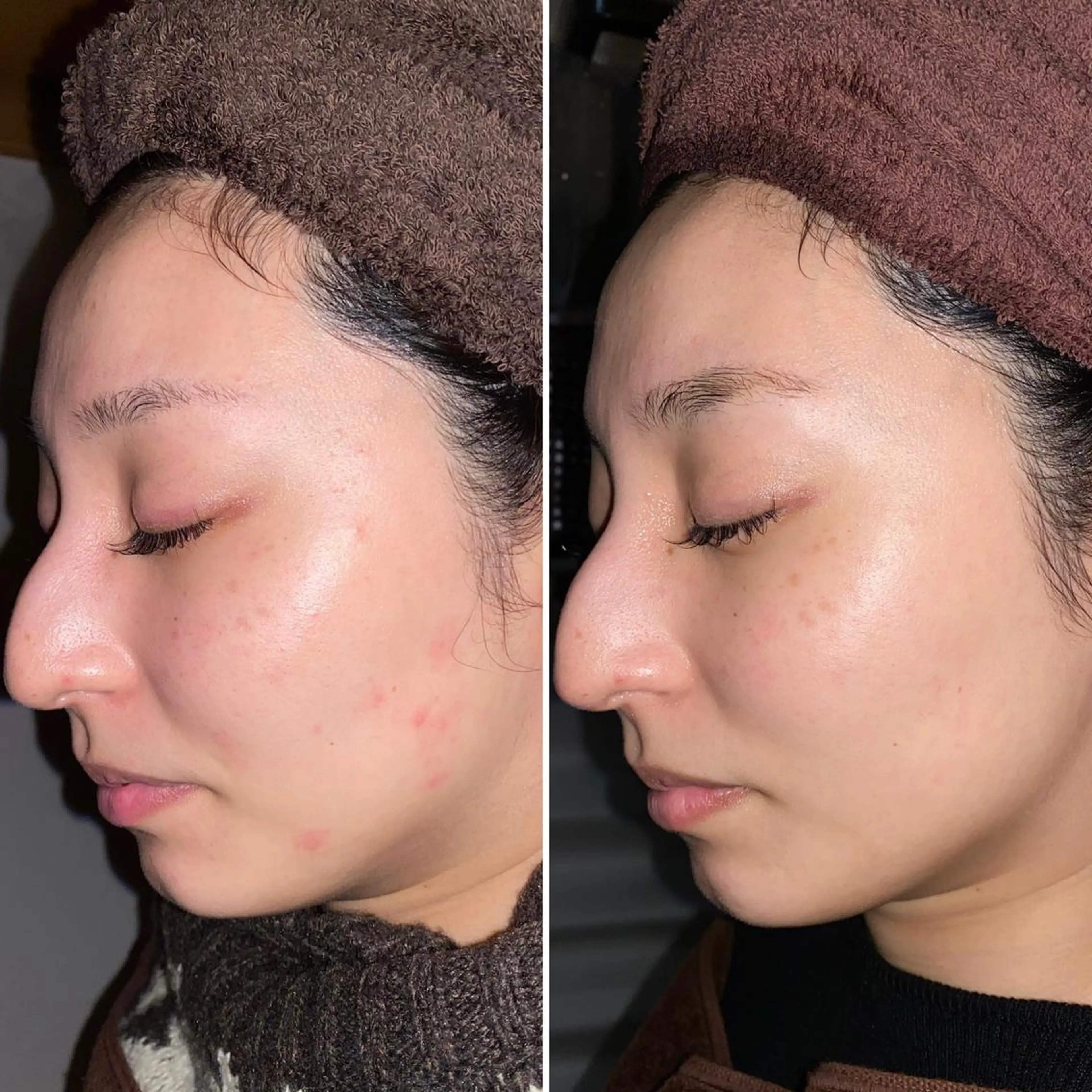 即小顔♥️美容鍼× ハーブピーリングのその他イメージ