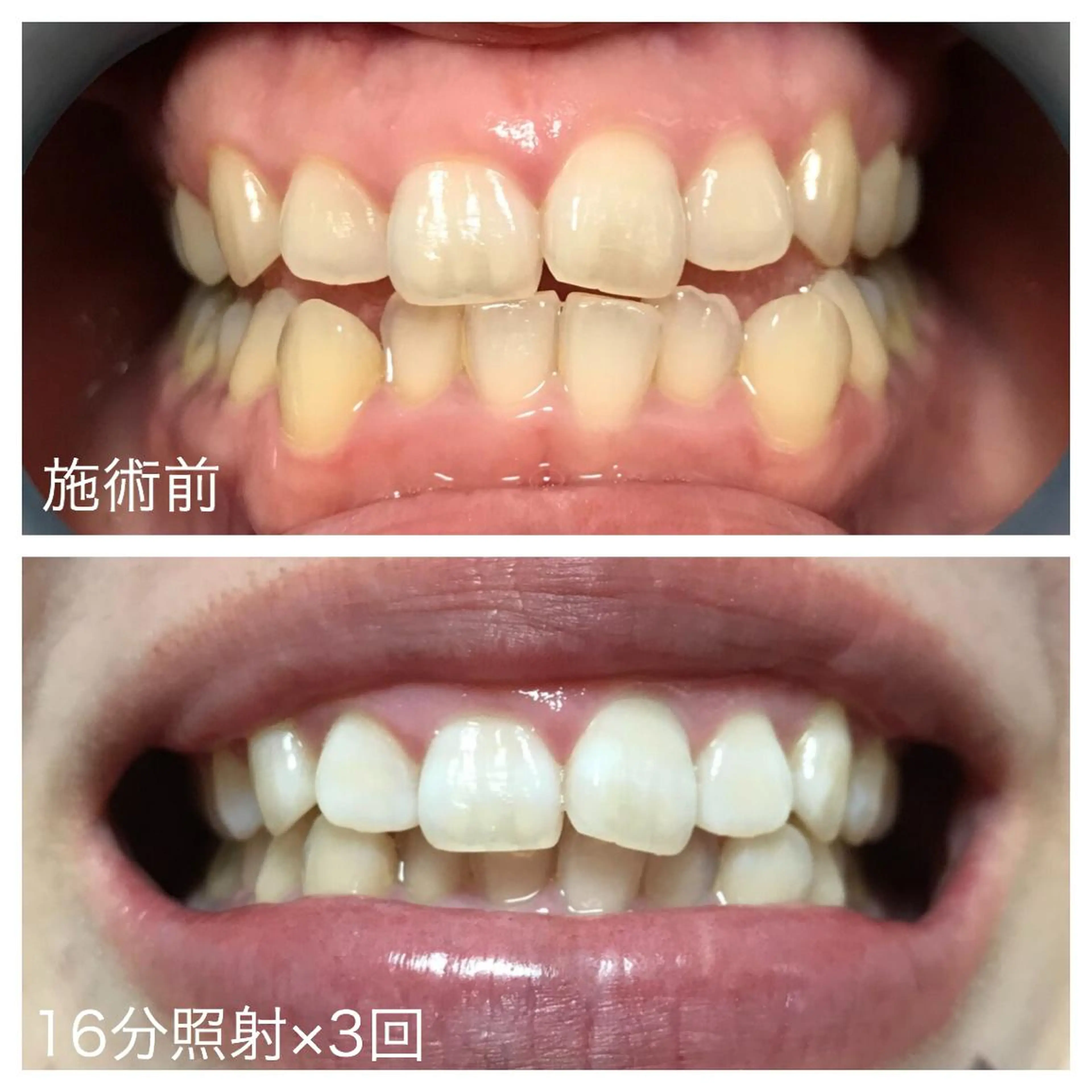 ネイル/耳つぼ /新ホワイトニングのネイルデザイン