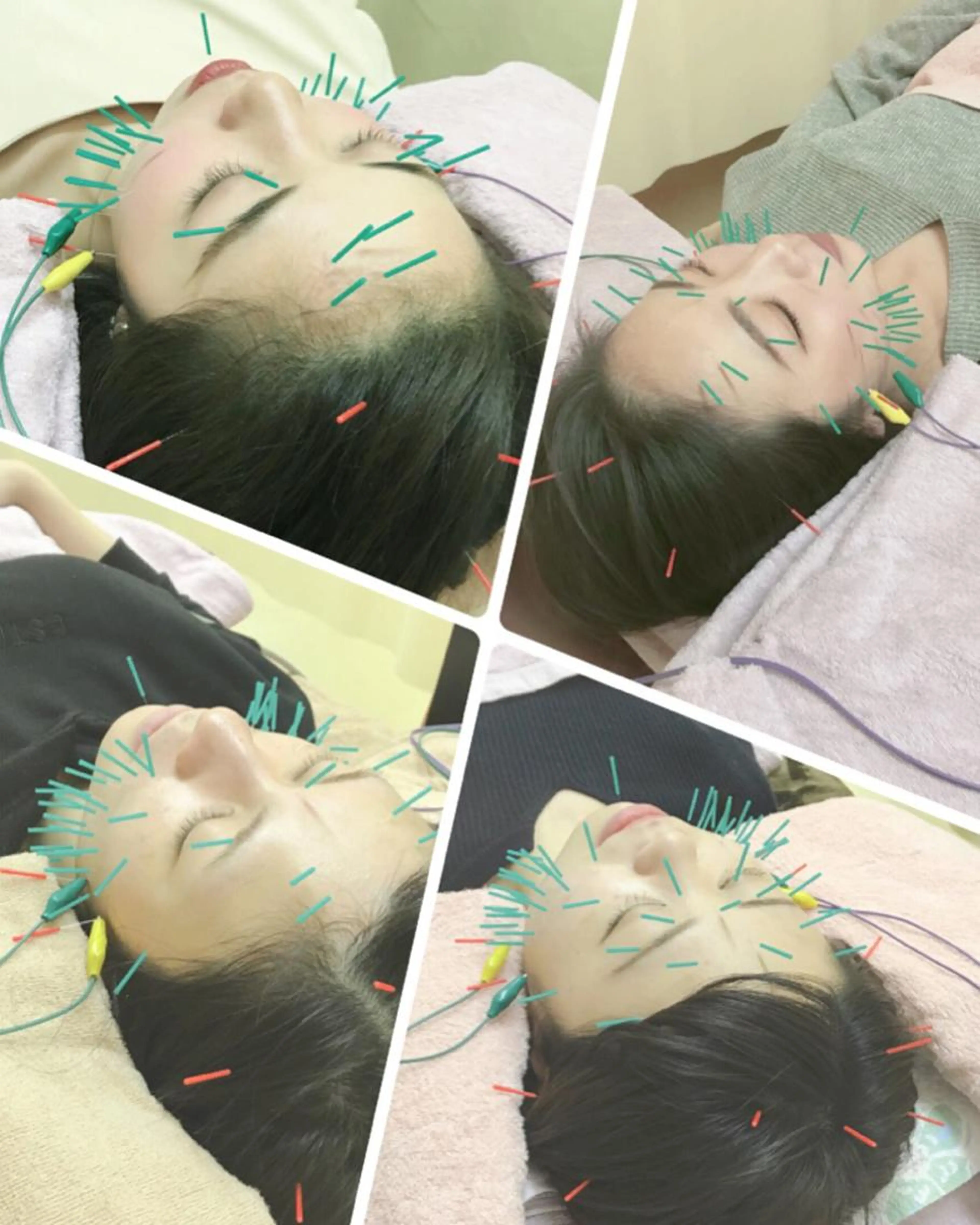 ✨初回の方限定✨お肌のトラブルやリフトアップ、小顔ご相談ください😊の写真