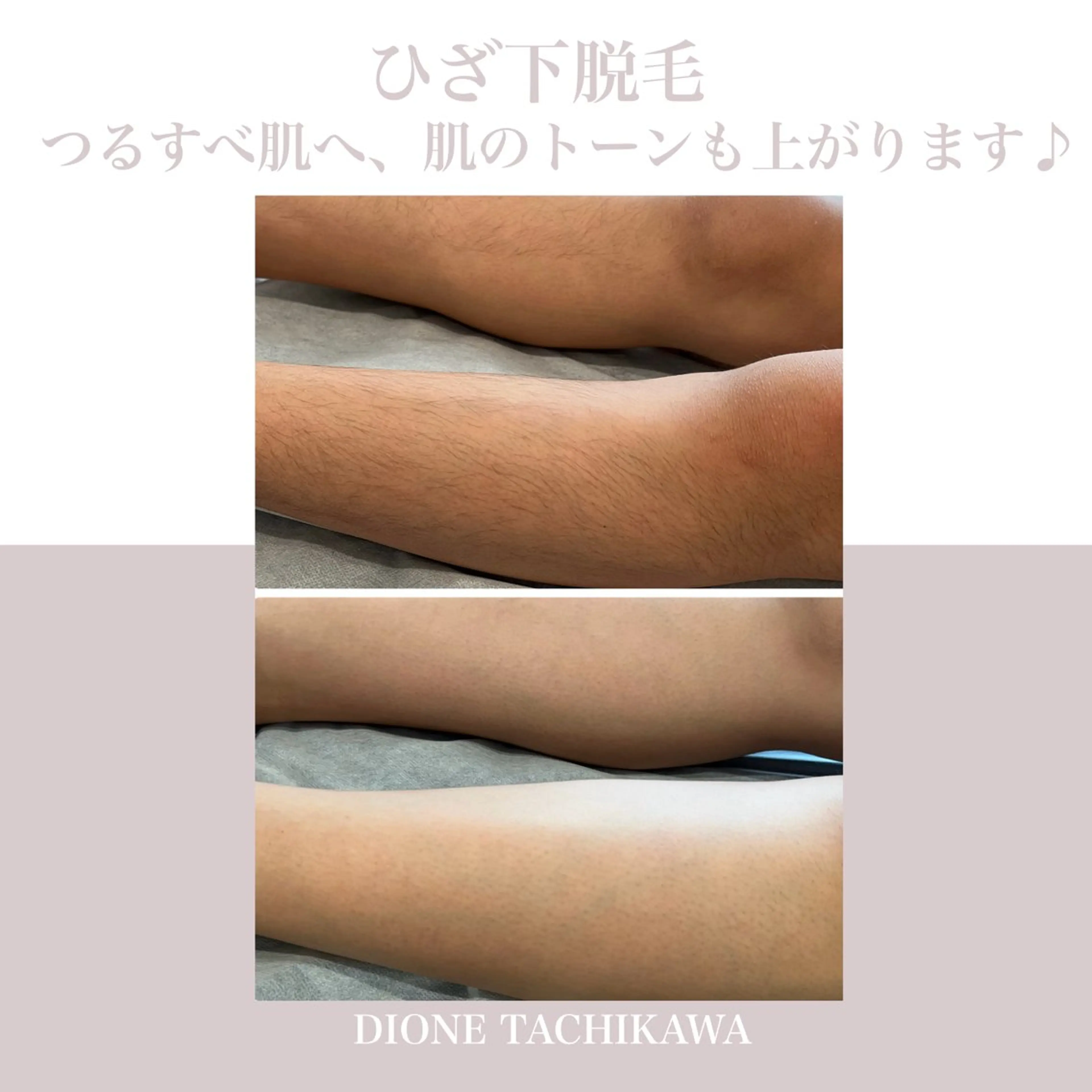 脱毛 【リベルハーブピーリング認定店】敏感肌・美白脱毛専門店Dione立川店所属・Dione 立川店のエステ・リラクイメージ