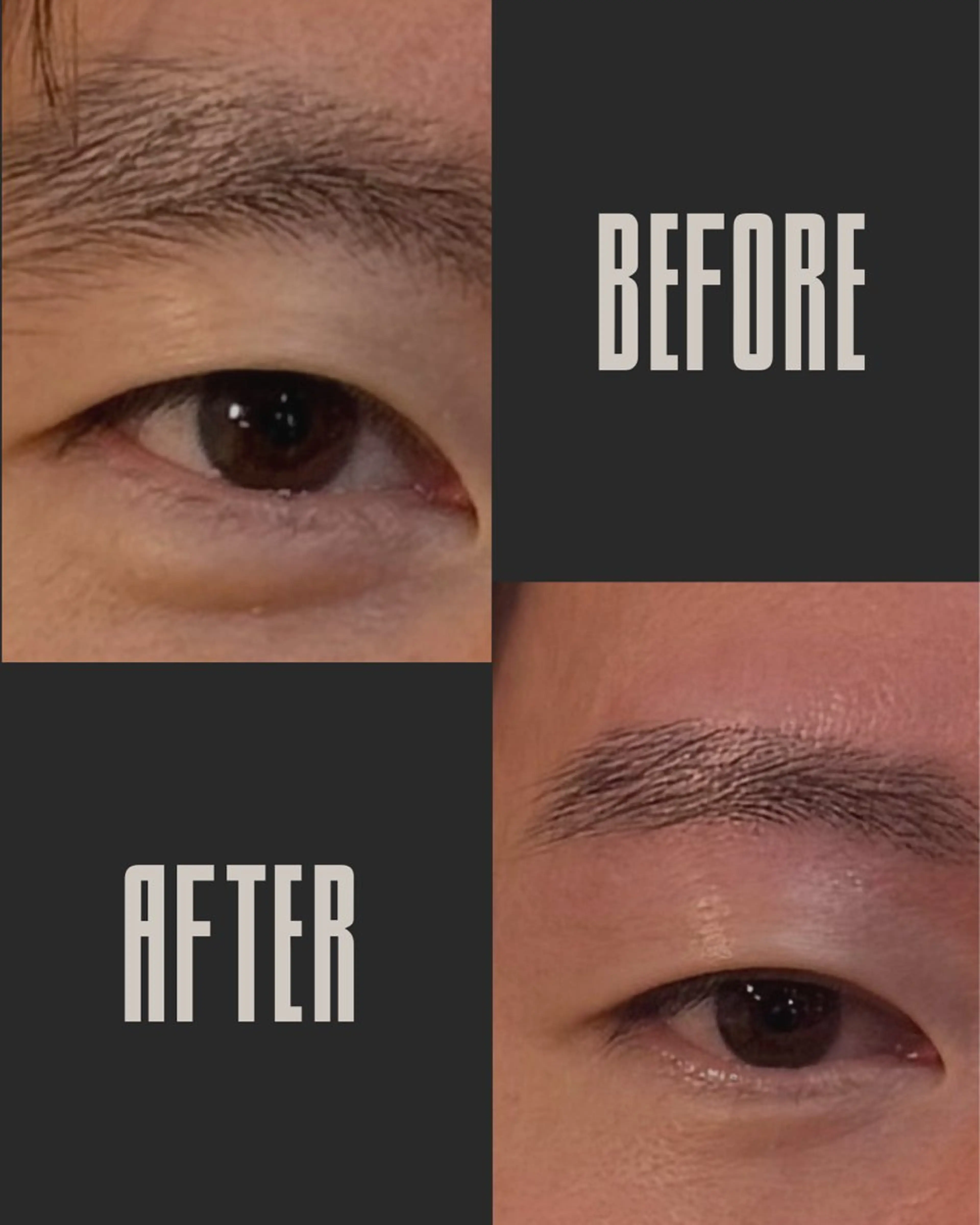 【男性限定】Wax脱毛の写真