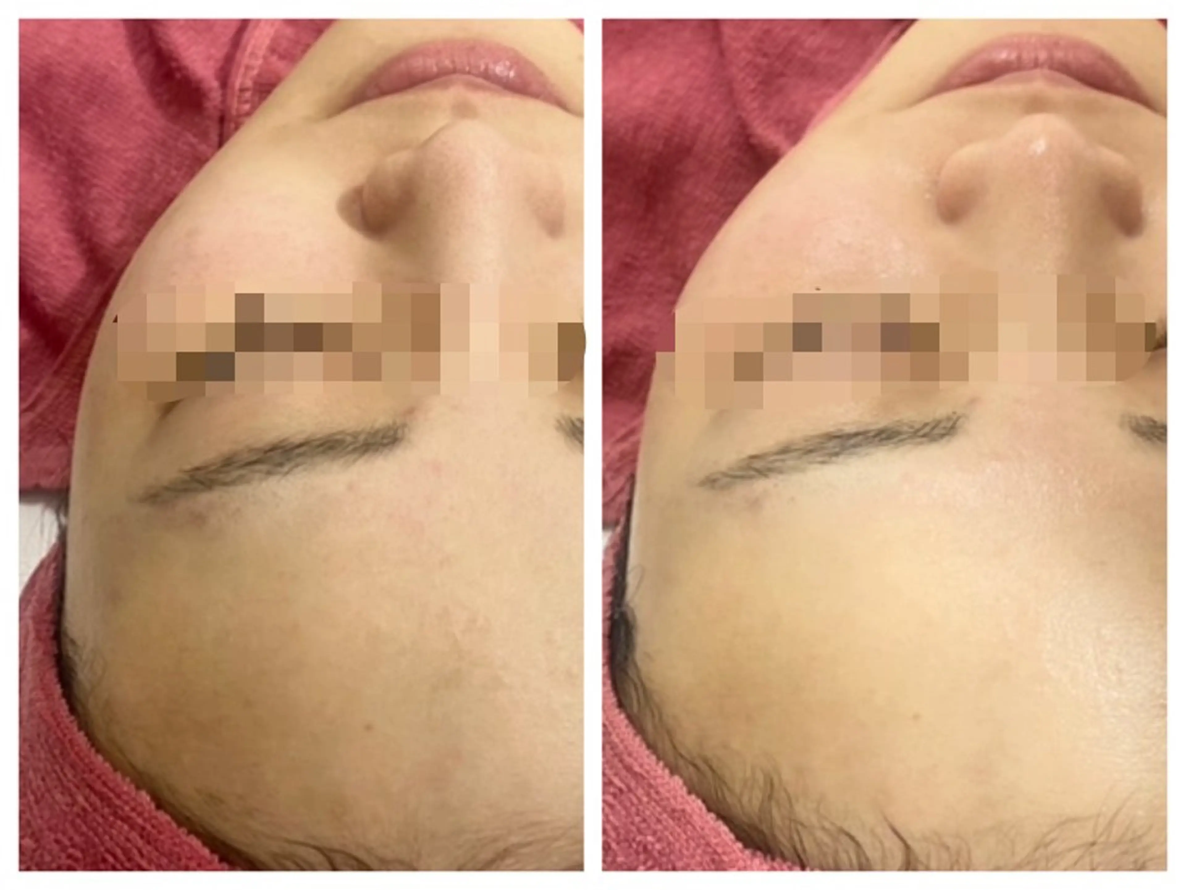 🧏🏻‍♀️全顔フェイシャルワックス脱毛【モデルさん募集】の写真