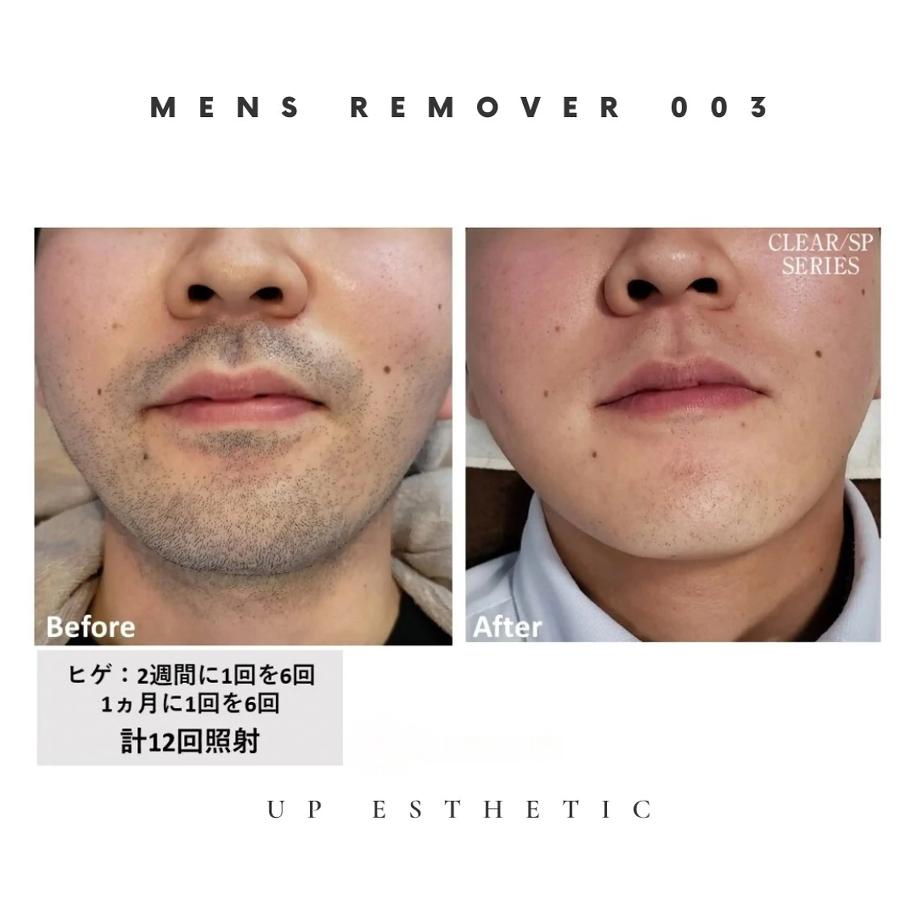 メンズ アイブロウ メンズアイブロウ 眉毛ワックス脱毛 脱毛 ウプエステティック所属・韓国肌管理 ウプエステティックのエステ・リラクイメージ