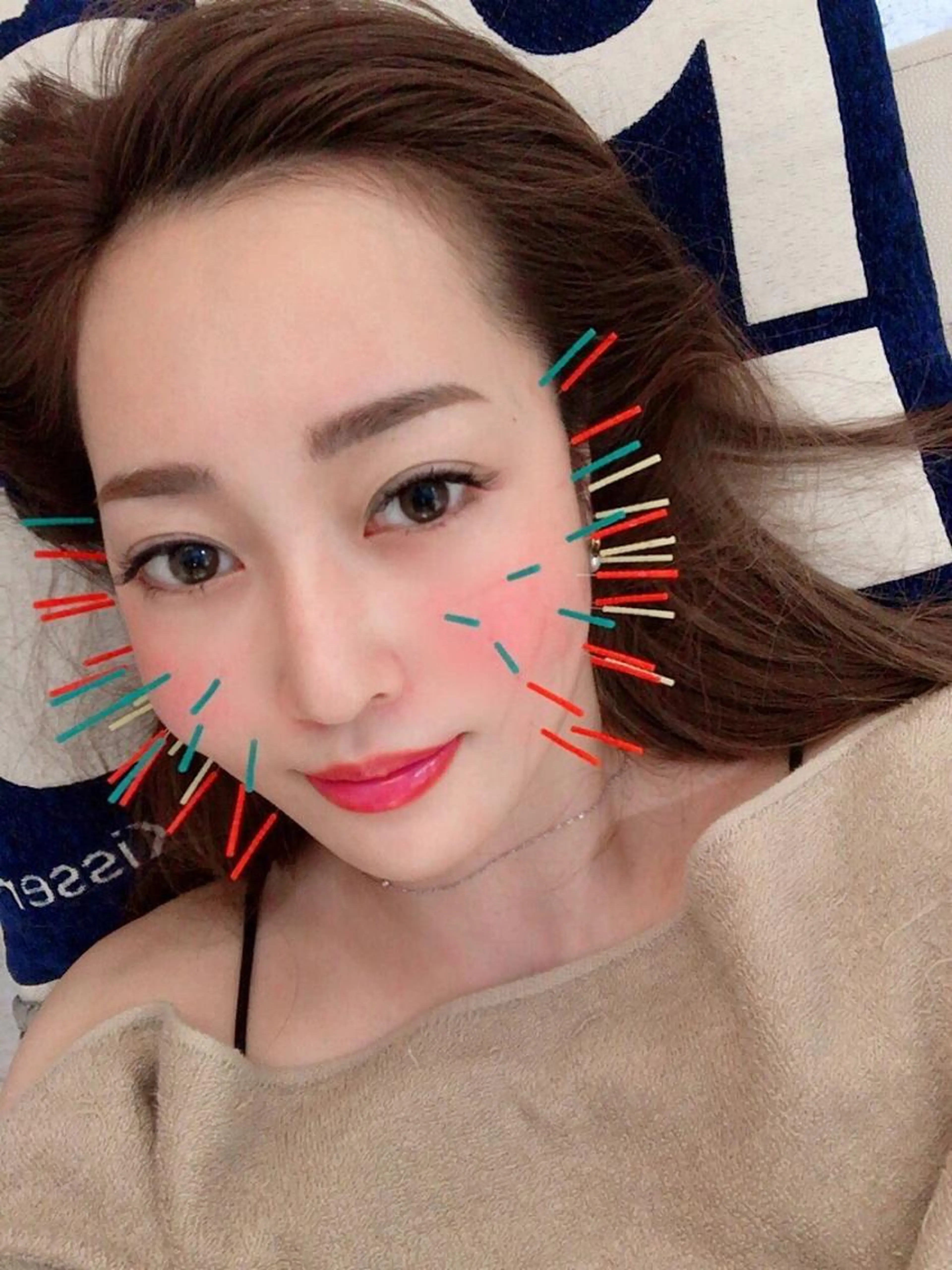 HYBRID美容鍼(小顔整体＋美容鍼＋炭酸ミスト＋ヘッドマッサージ)当院のHYBRID美容鍼は100本の鍼を使用しますの写真