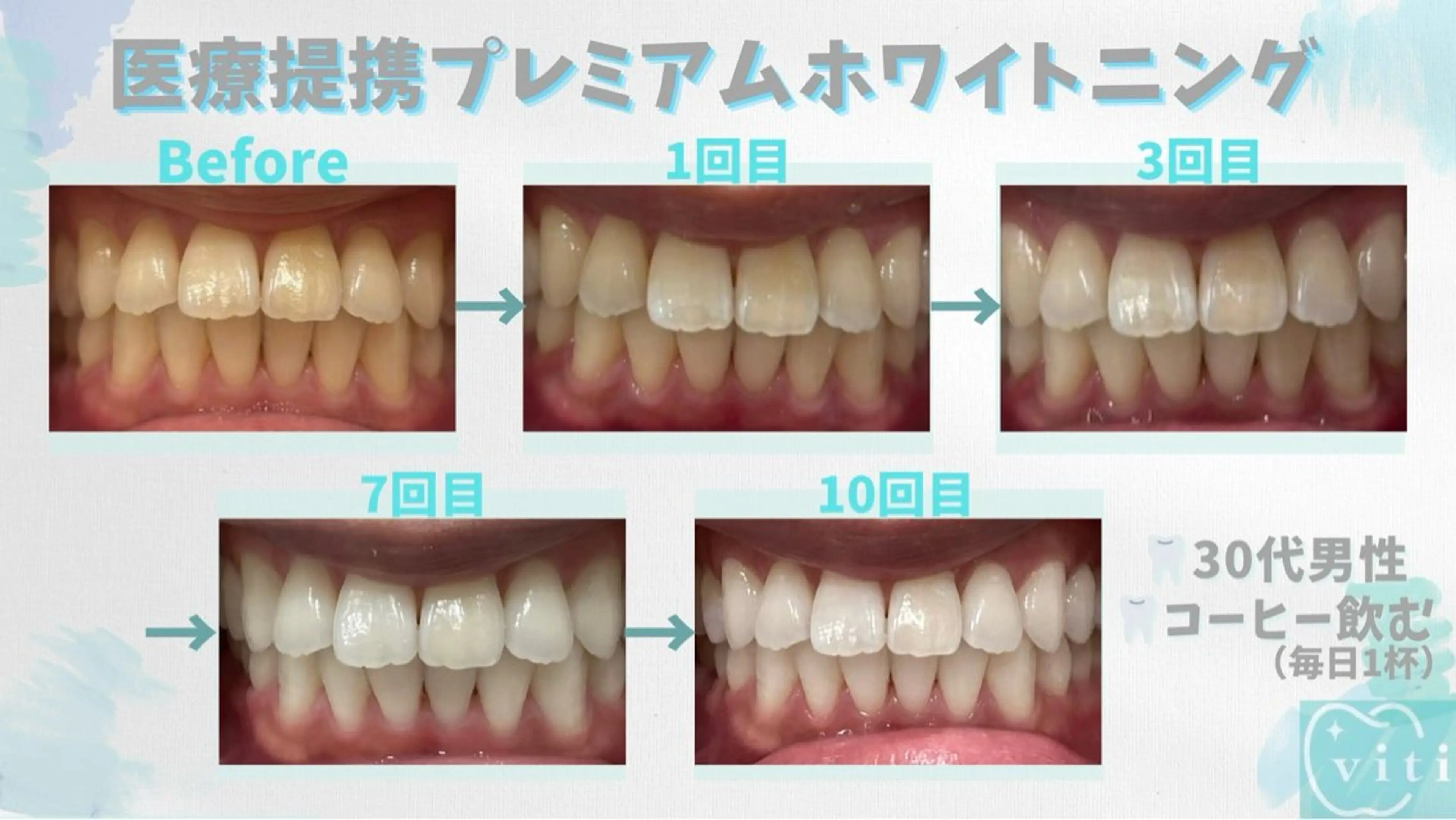 💚医療提携プレミアムセルフホワイトニング💚30分の写真