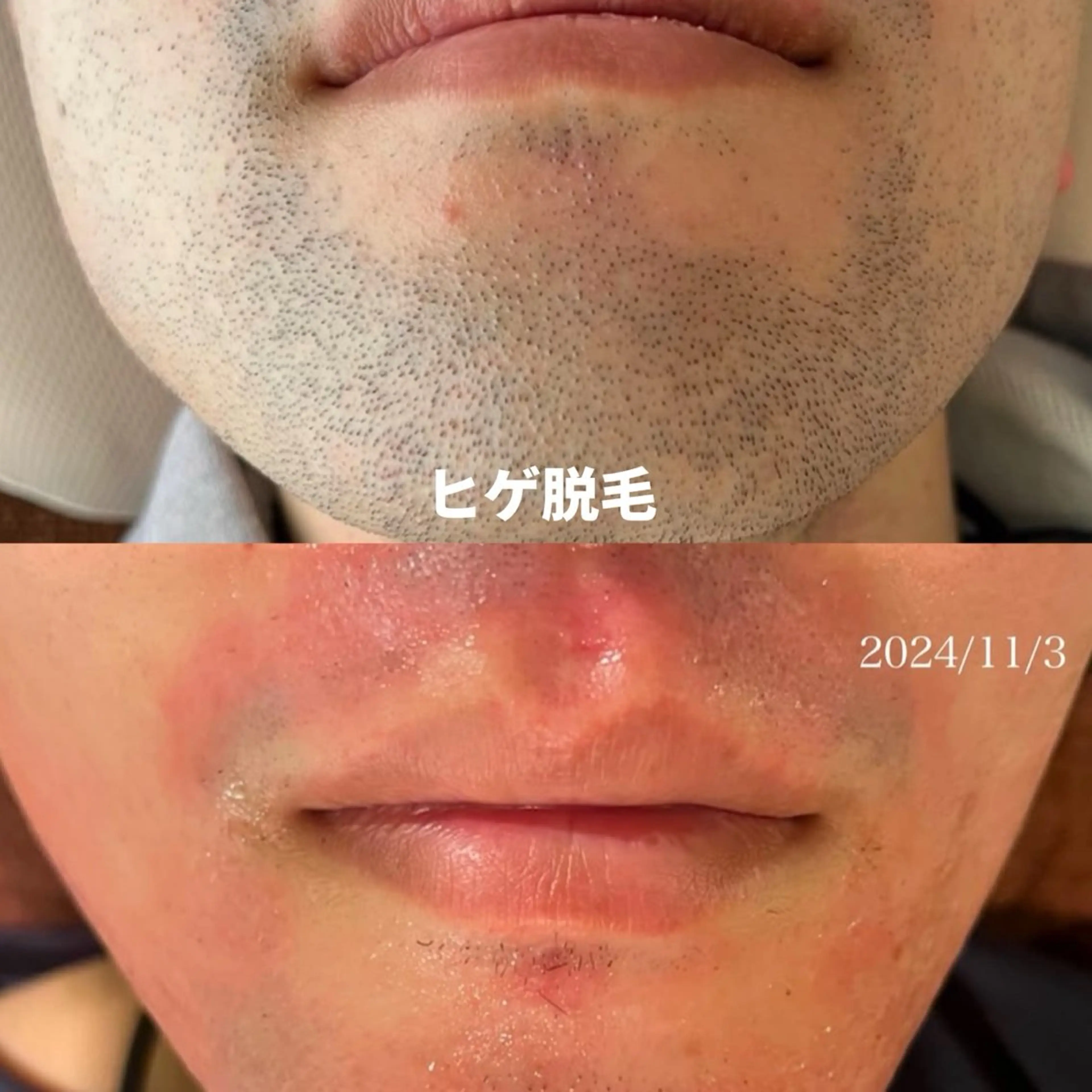 ヒゲ脱毛の写真