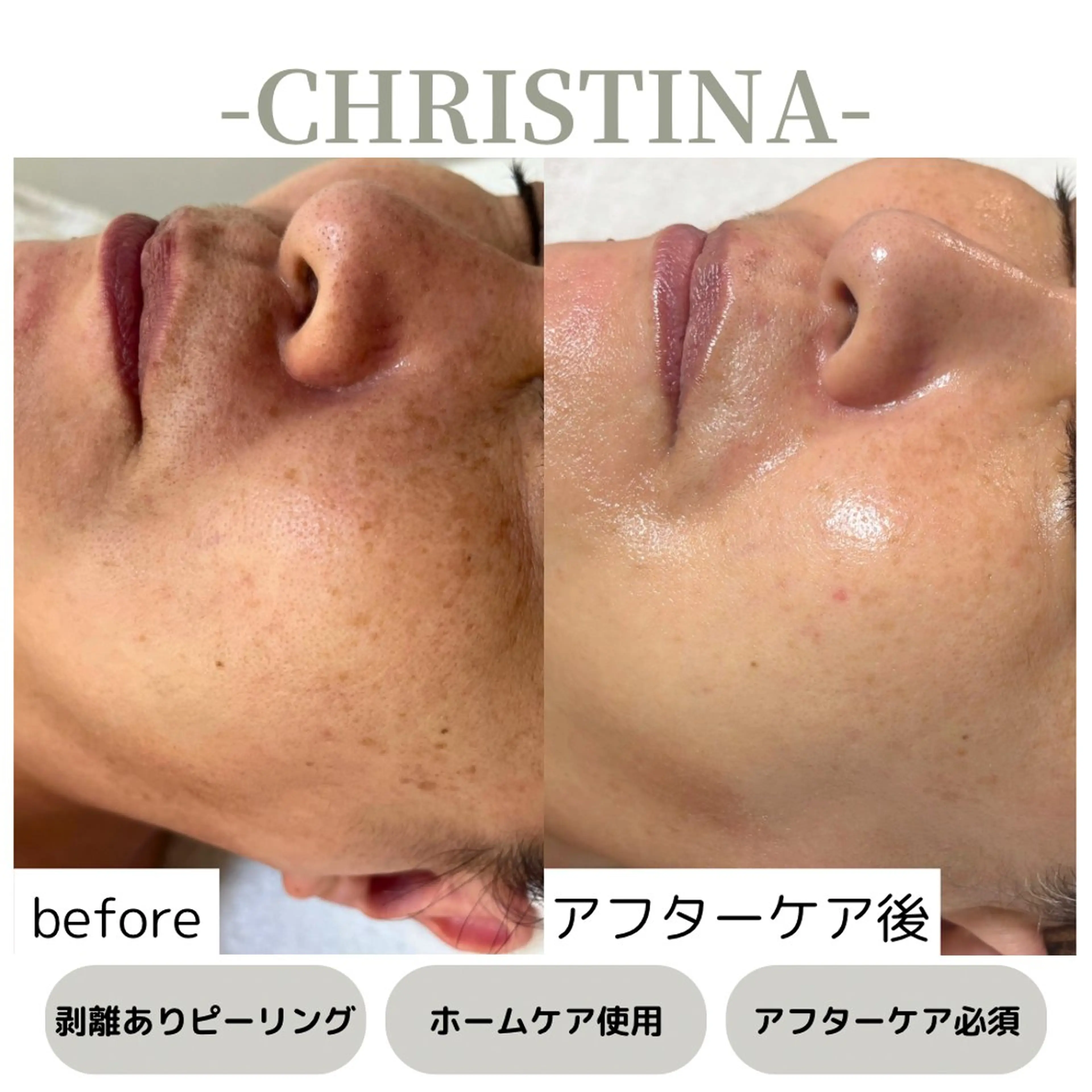 【アクティブピーリング🪸】根本改善にはこれ！肌総入れ替え✦ローズドメーラ|クリスティーナ天王寺・大阪💎の写真