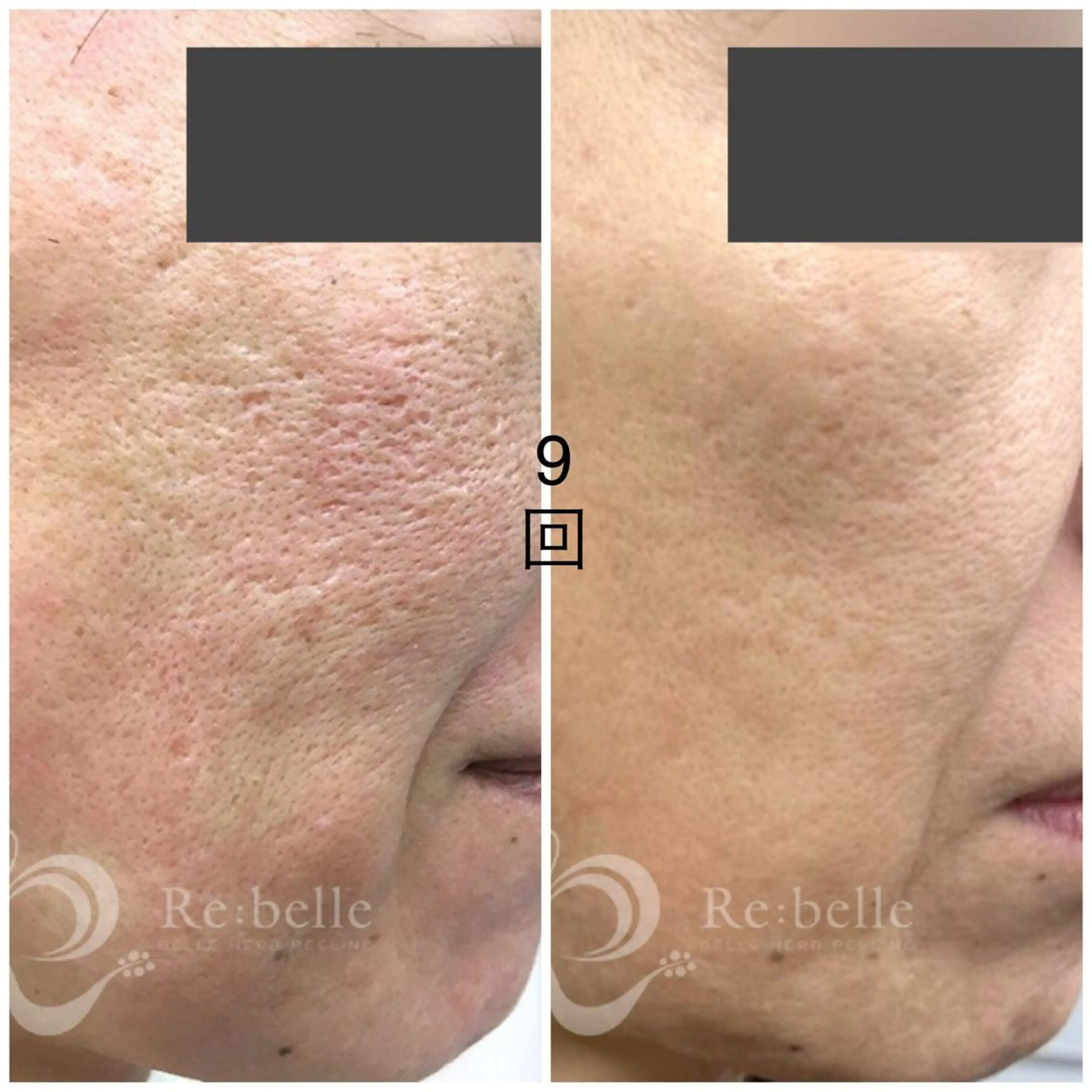 特別初回モニターハーブピーリングの写真